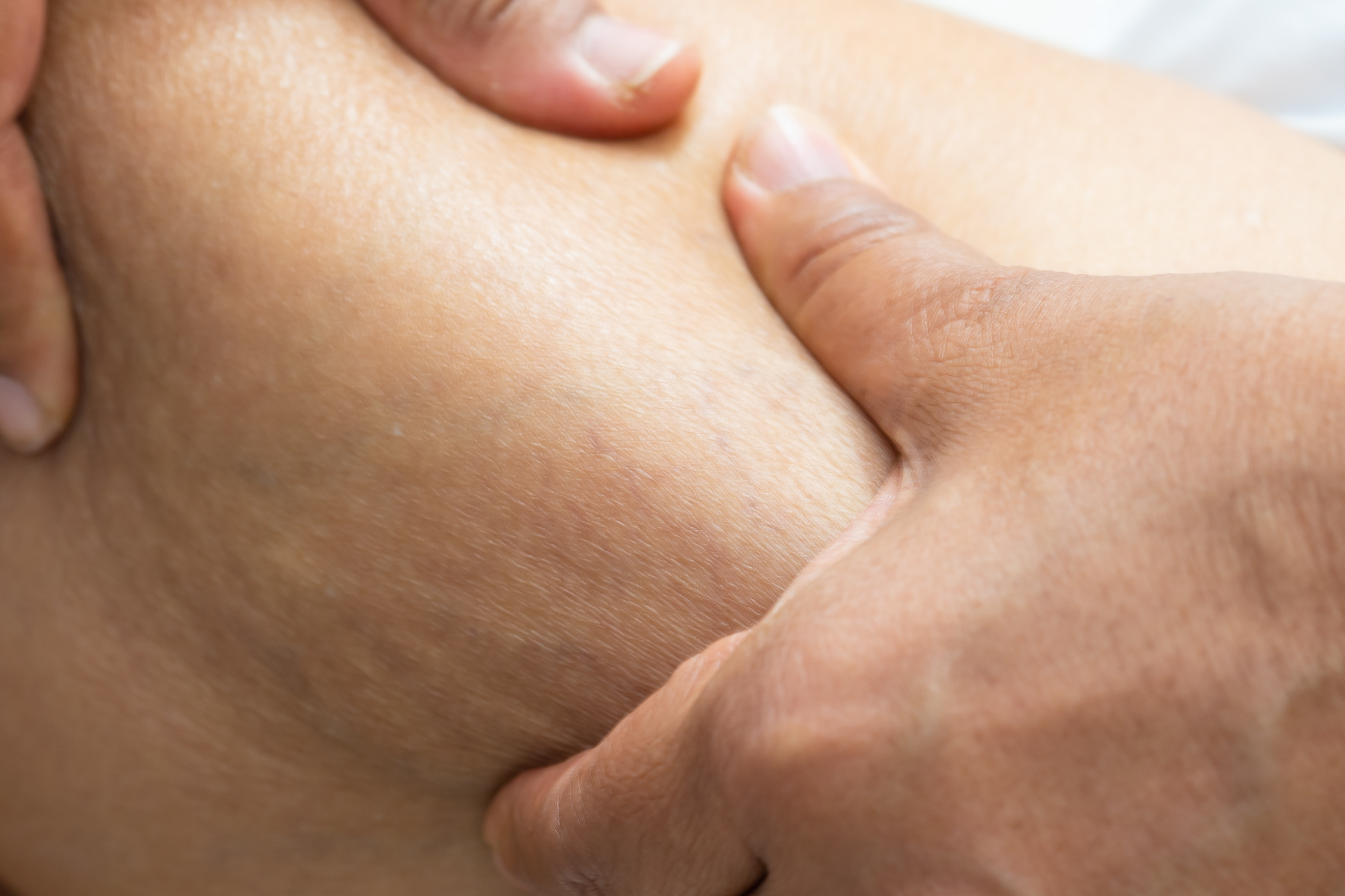 السيلوليت الدهني (Adipose Cellulite)