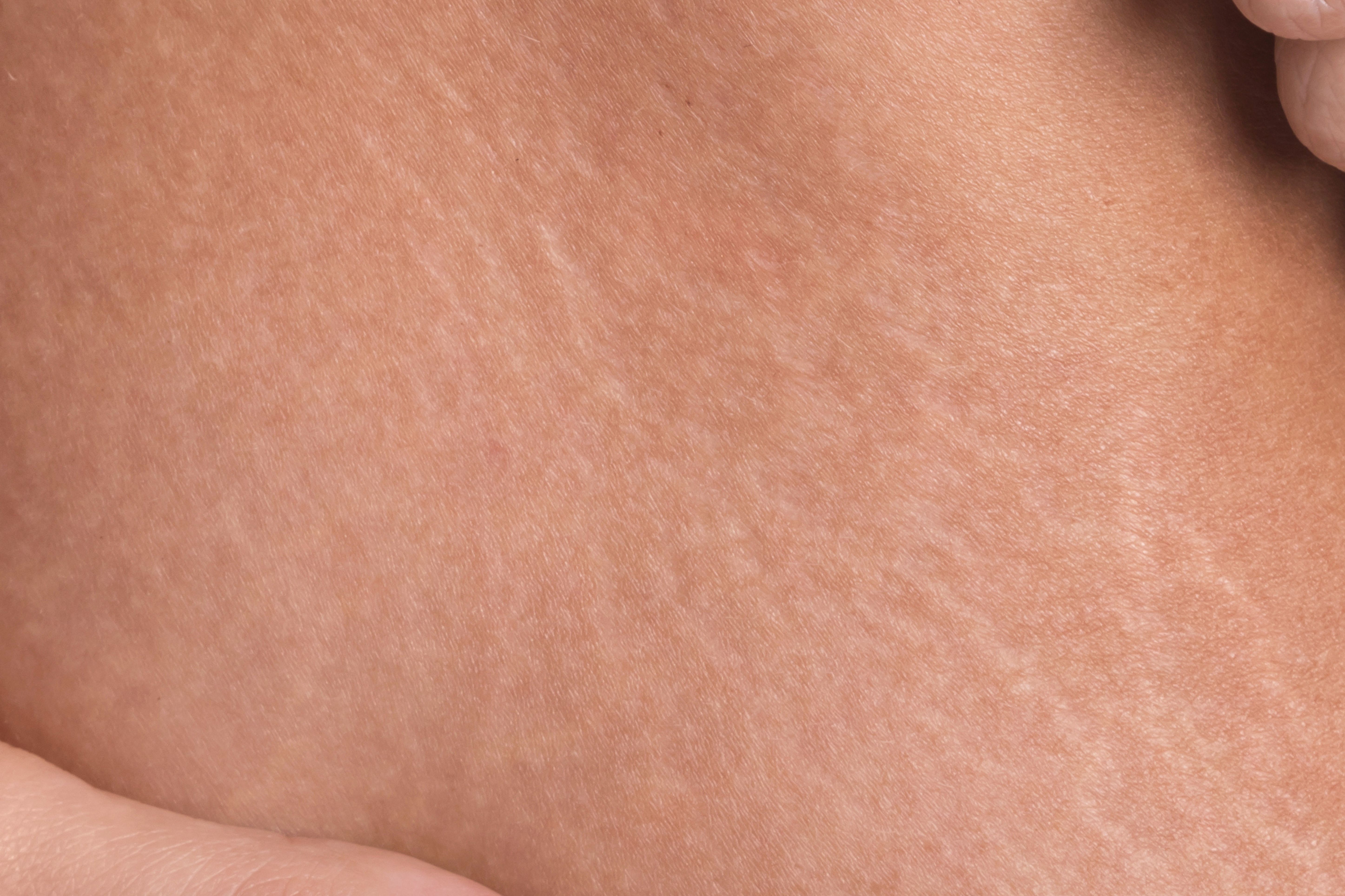السيلوليت المائي (Aqueous Cellulite)