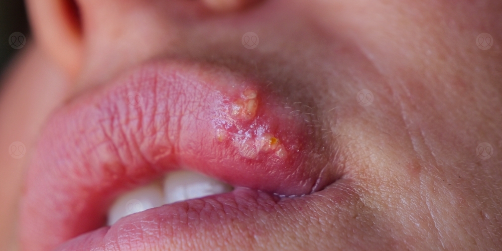 حبوب الشفاه