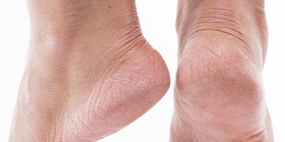 تشققات القدمين