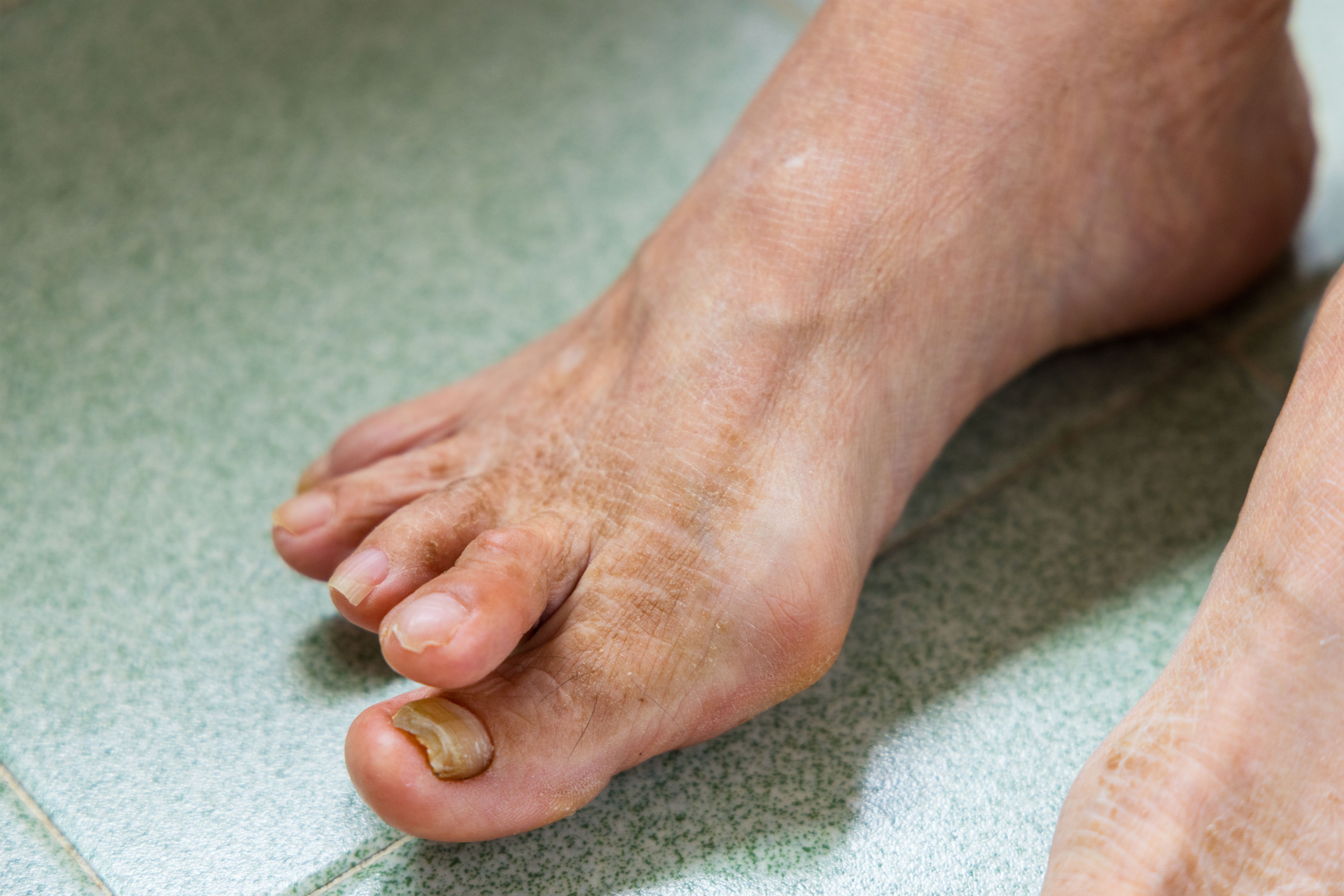 فطريات أظافر القدم (Nail Fungal Infections)