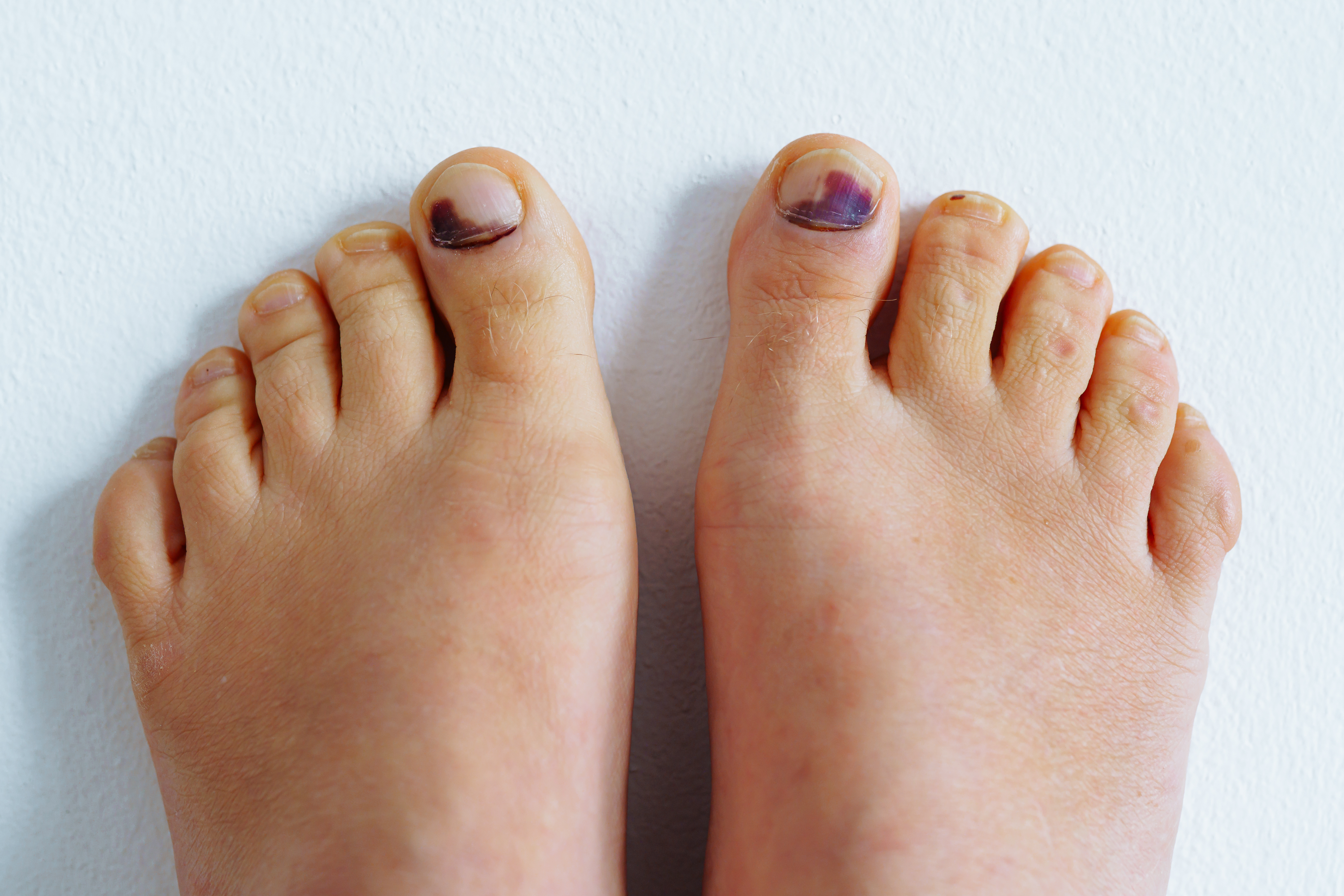 الإصابة أو الرضوض (Toenail Trauma)