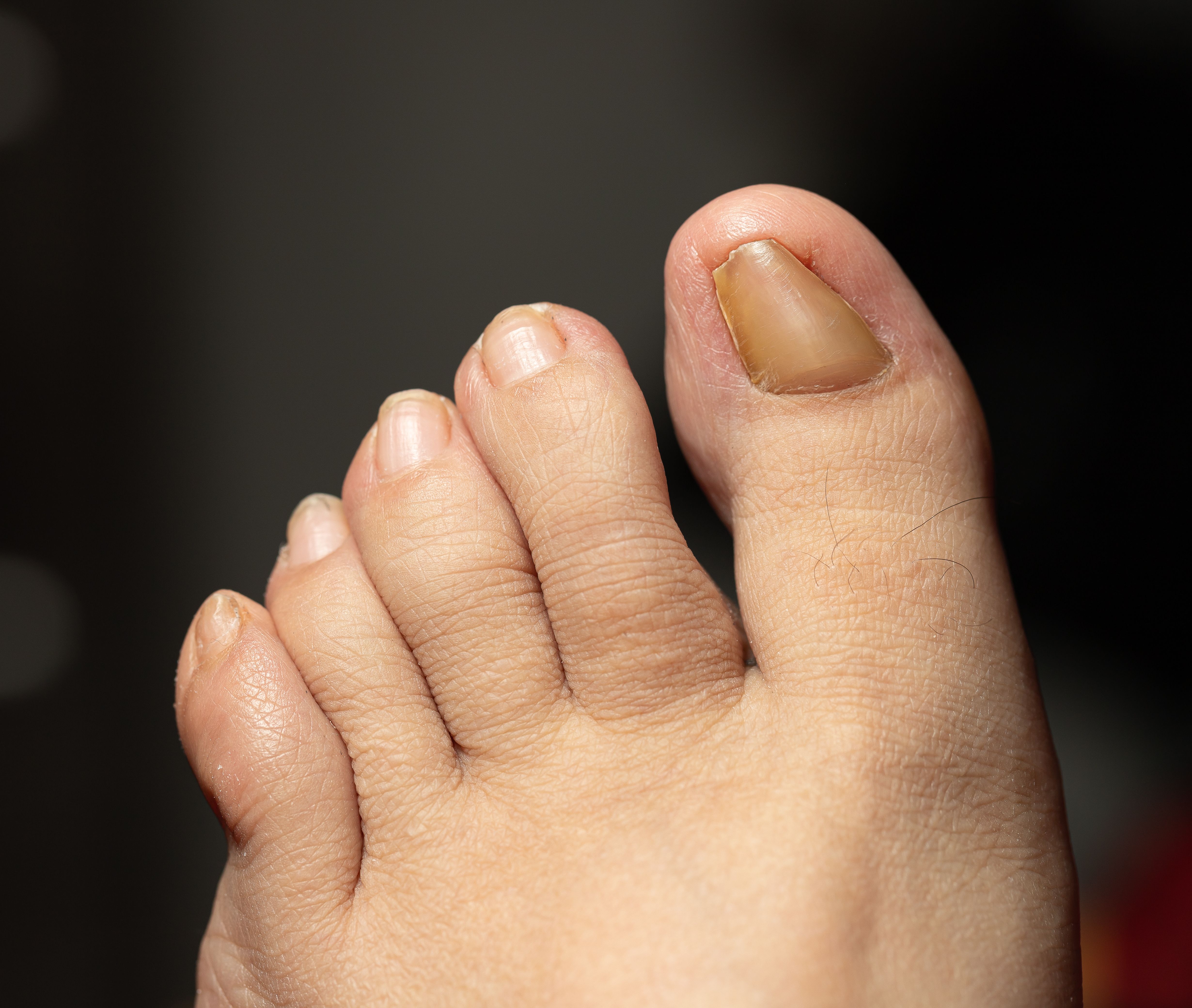 الظفر الناشب (Ingrown Toenails)