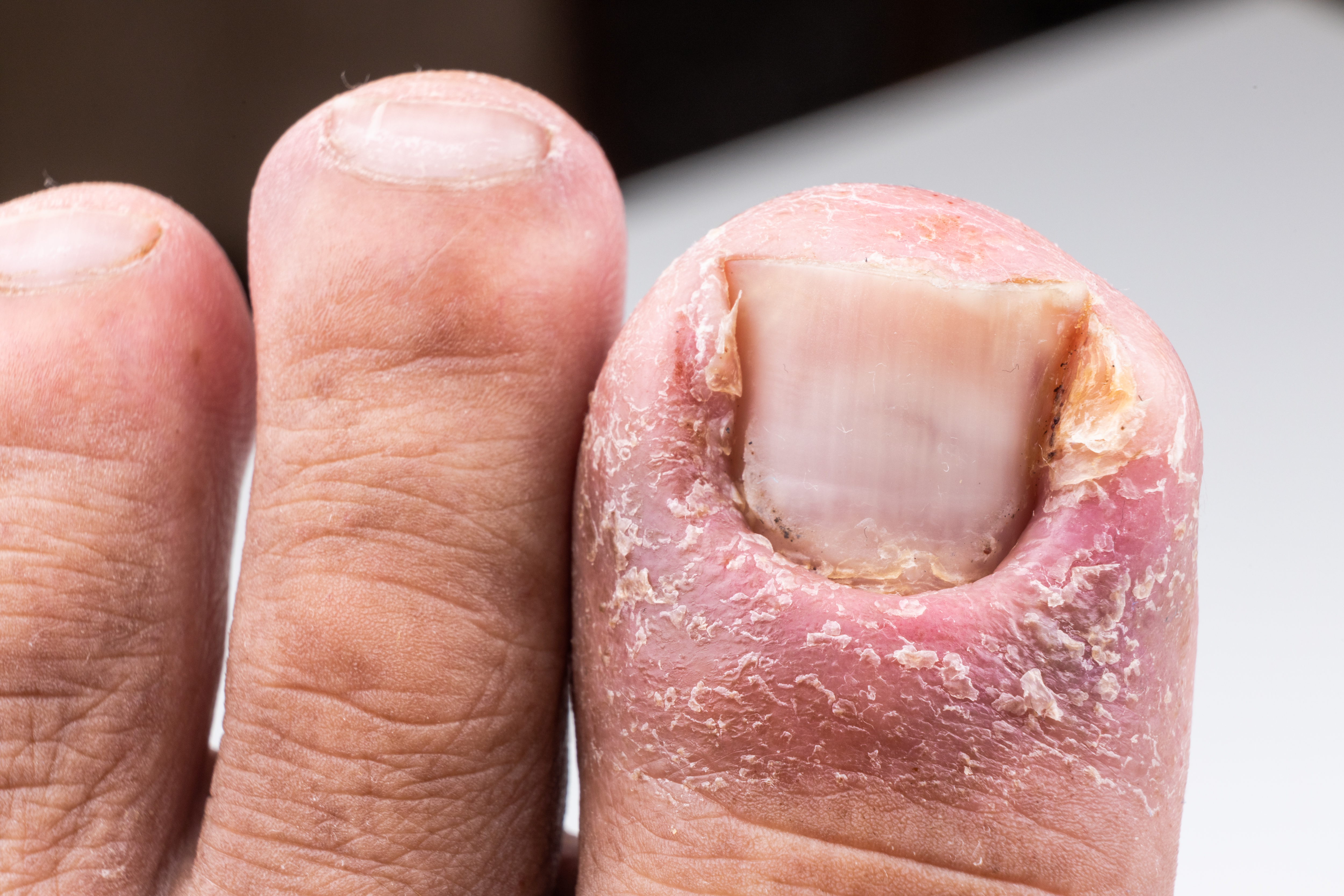 صدفية الأظافر (Nail Psoriasis)