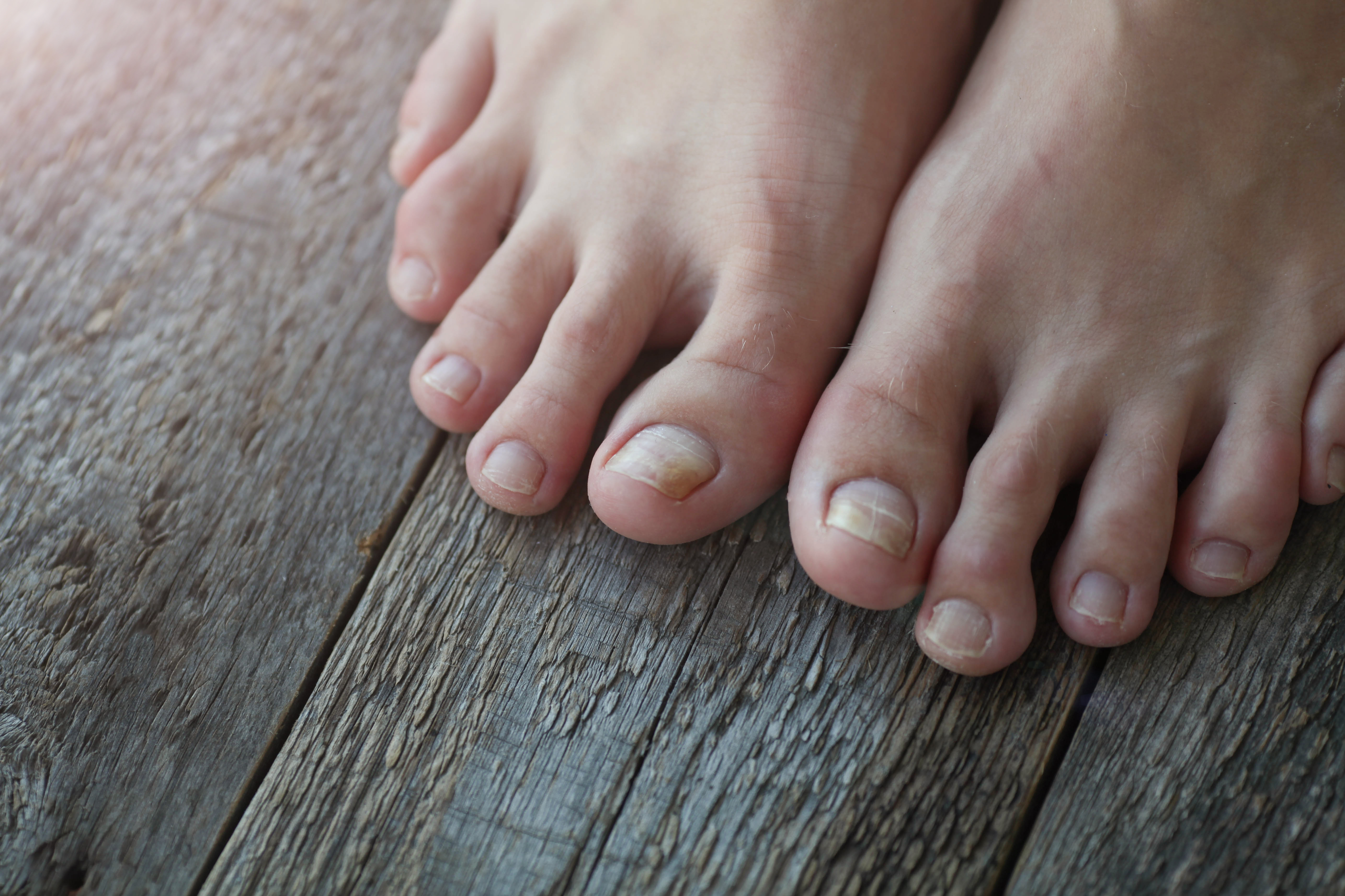 تعجر الأظافر (Clubbed Nails)