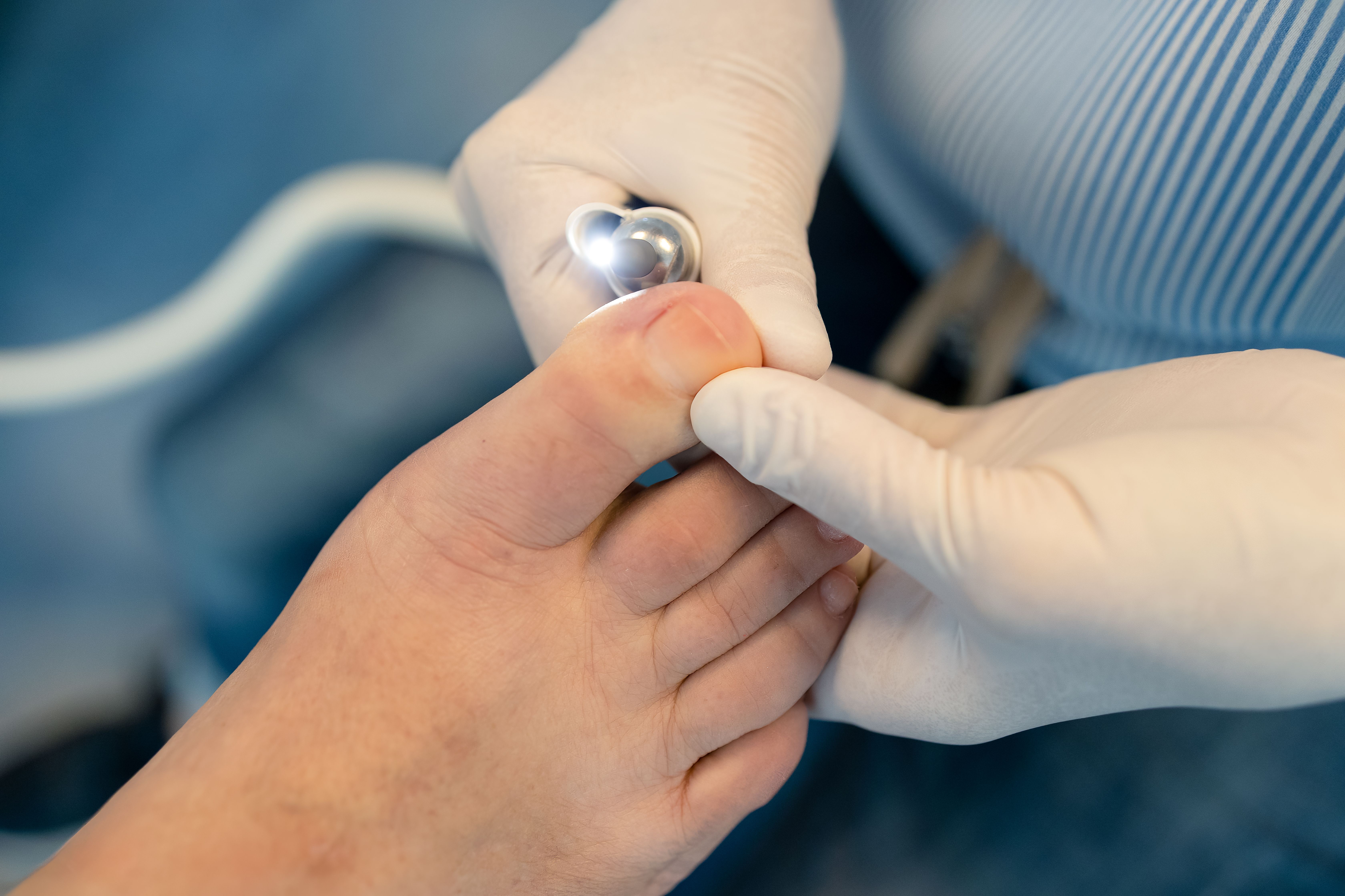 الحزاز المسطّح في الأظافر (Nail lichen planus)