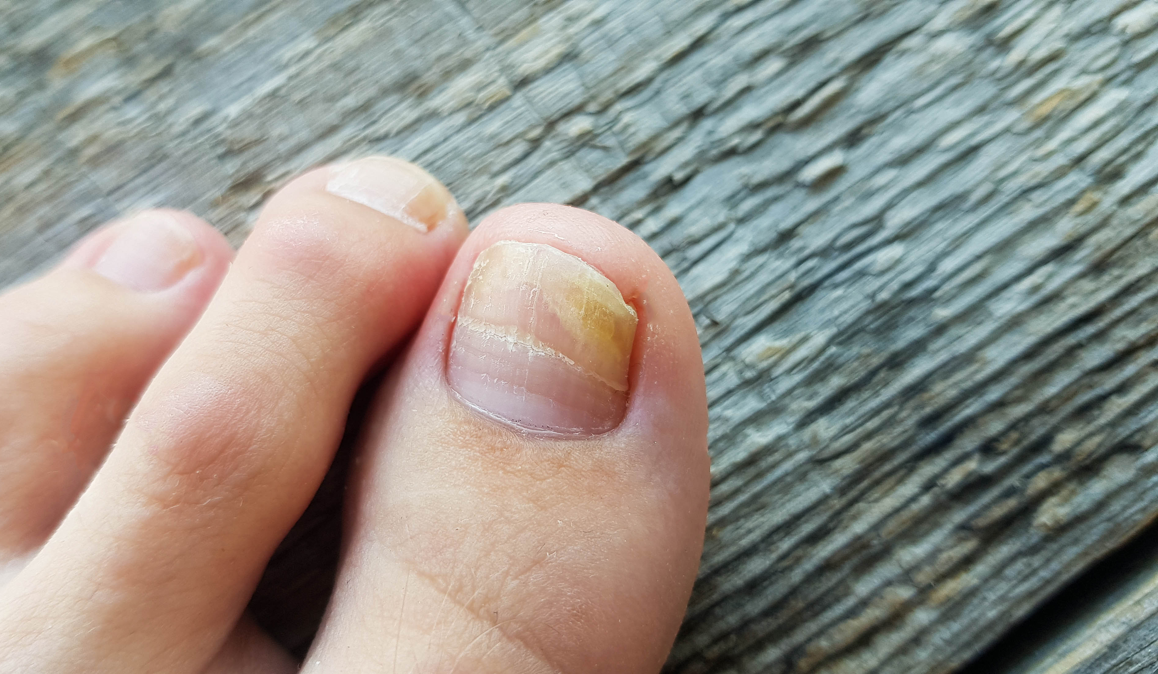 انفصال الظفر (Onycholysis)