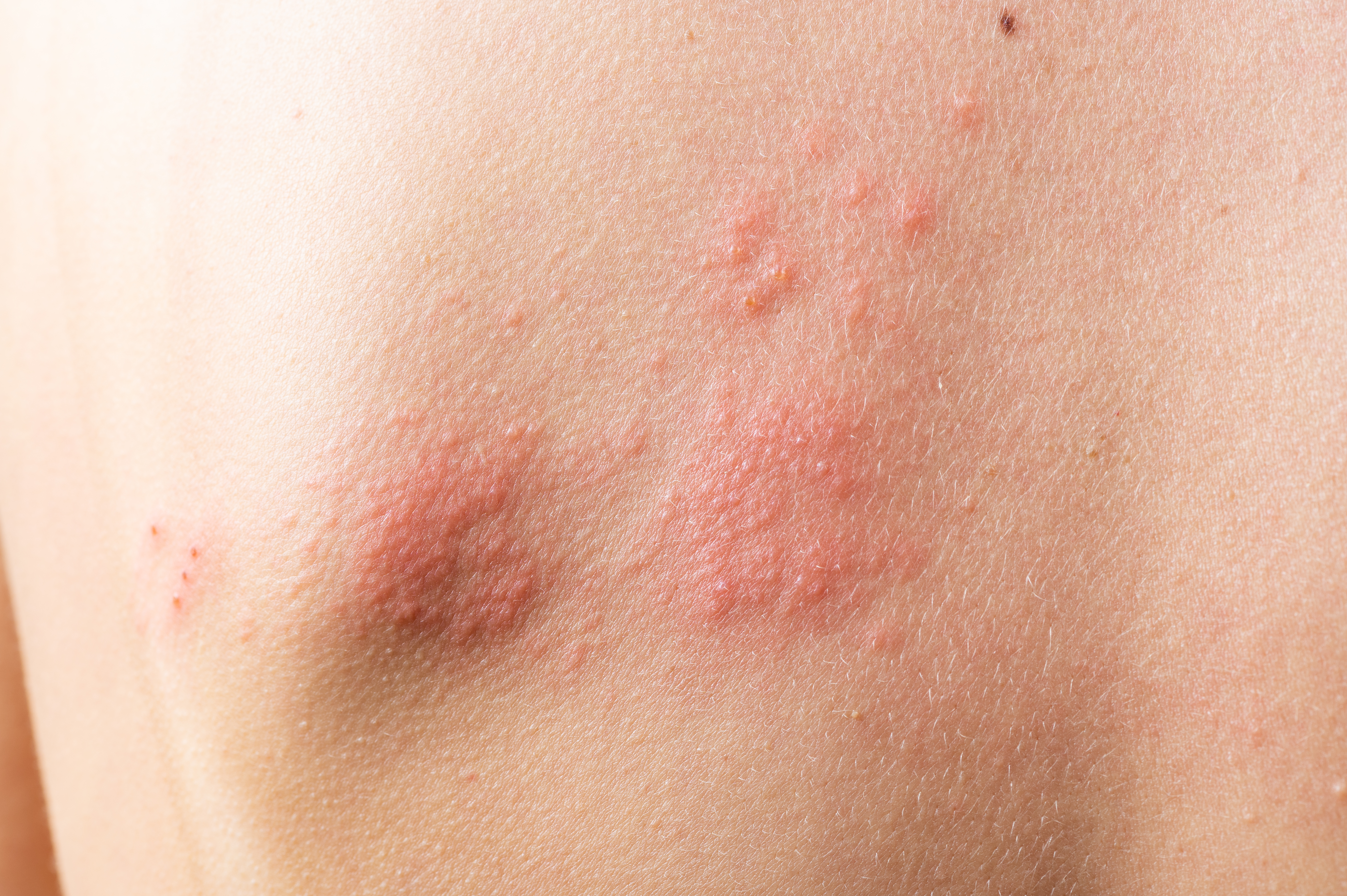 الحزاز المسطّح التناسلي (Genital lichen planus)