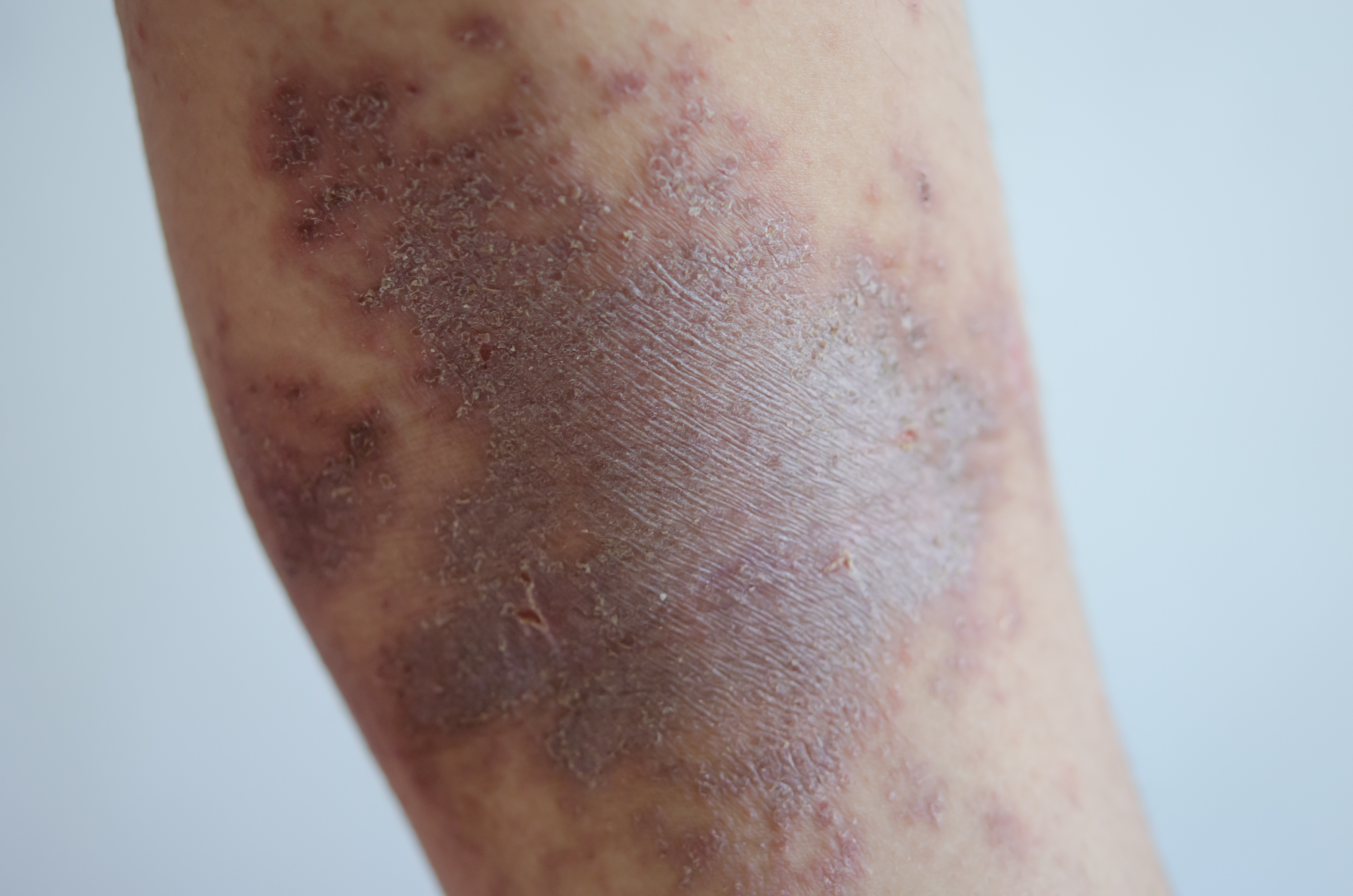 الحزاز المسطّح الجلدي (Cutaneous lichen planus)