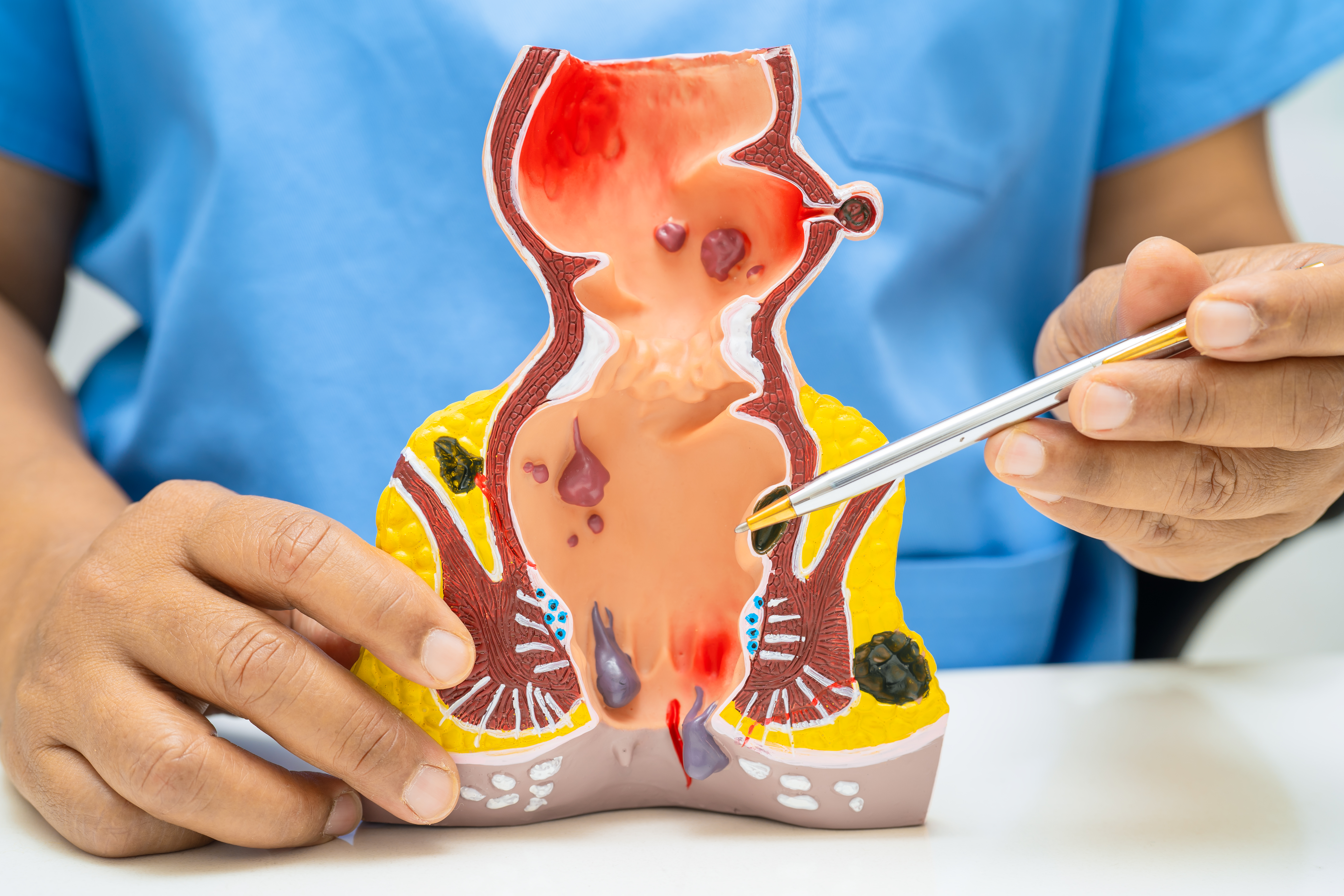 أعراض الناسور بالصور: هل تستدعي القلق؟