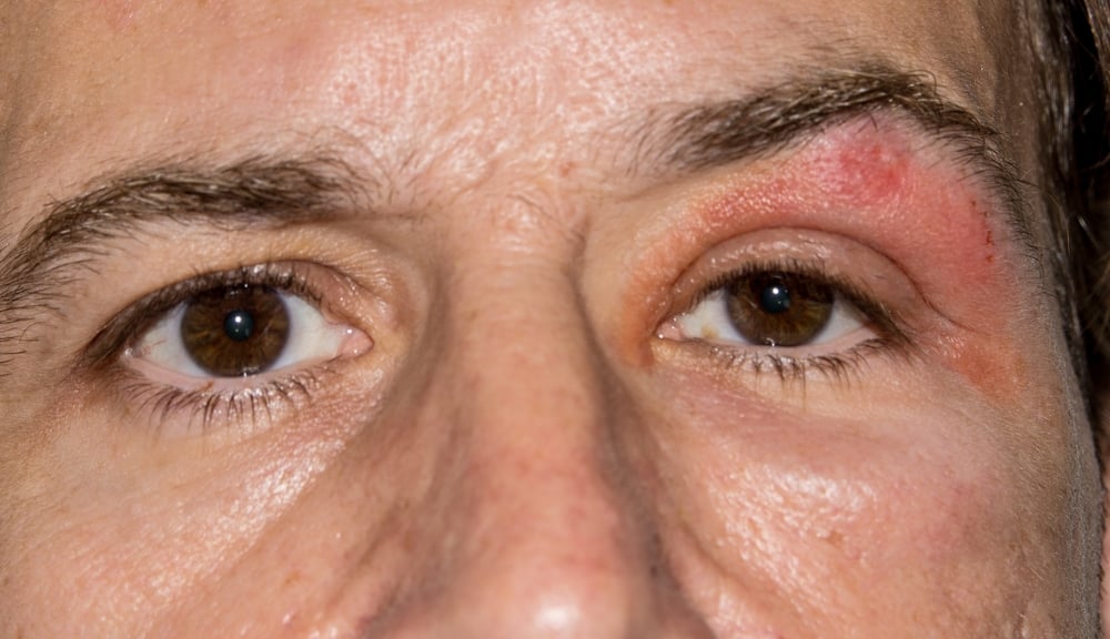 الحزام الناري في العين