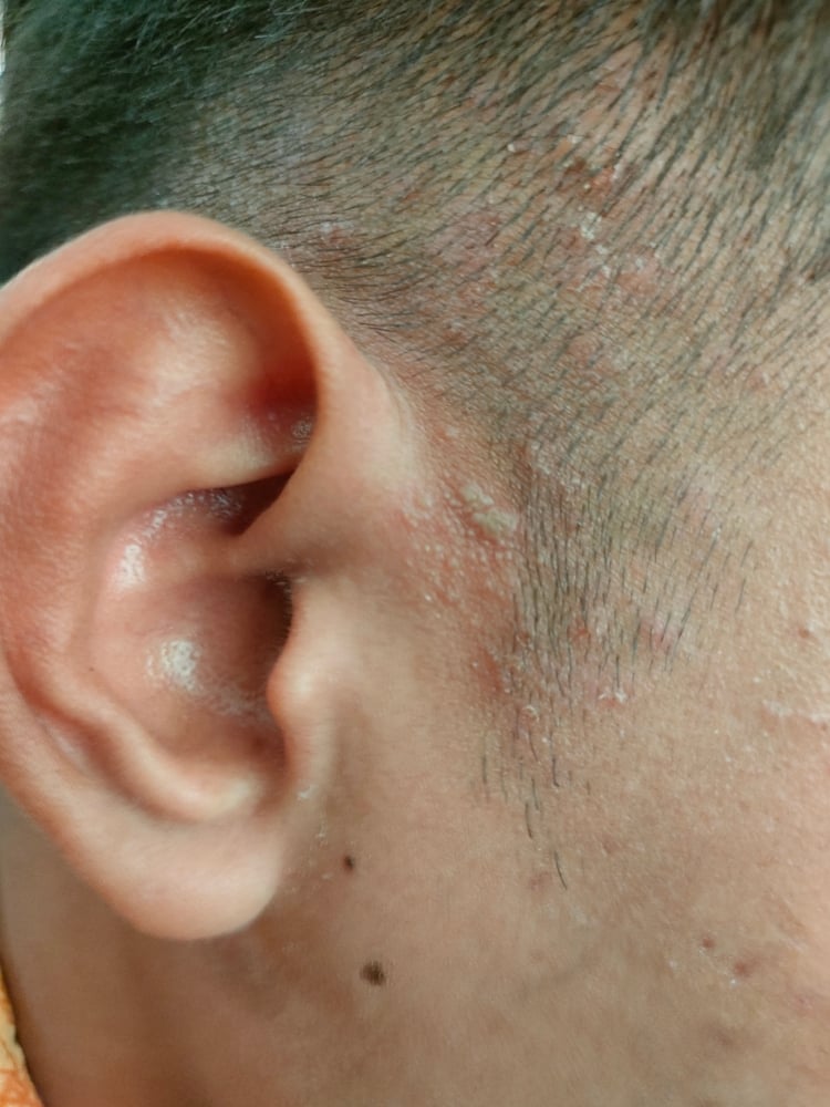 الحزام الناري على الأذن