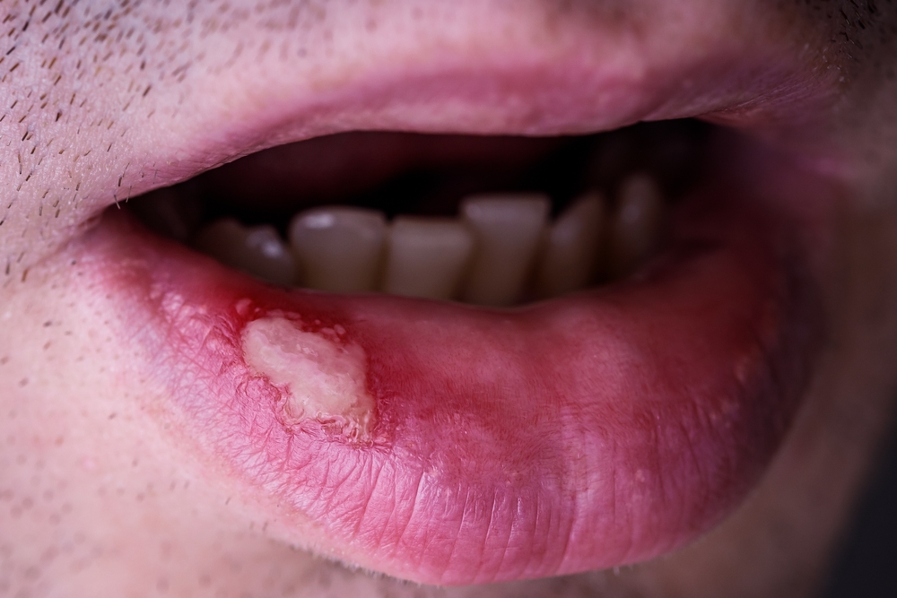 الحزام الناري في الفم