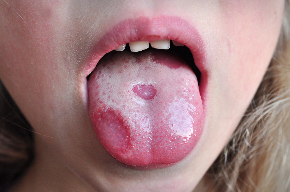 ما هو سرطان اللسان؟