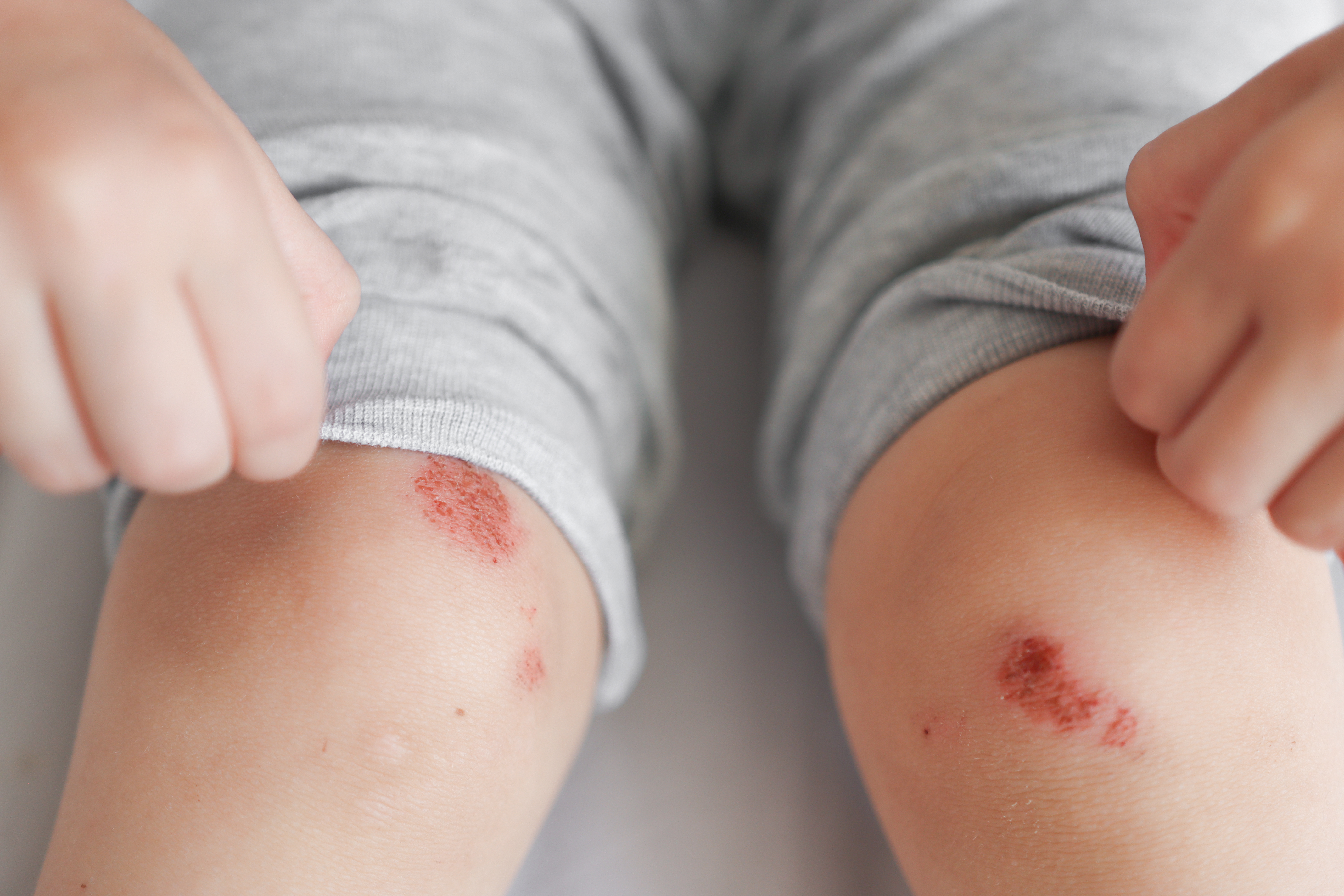 2. القوباء الفقاعية