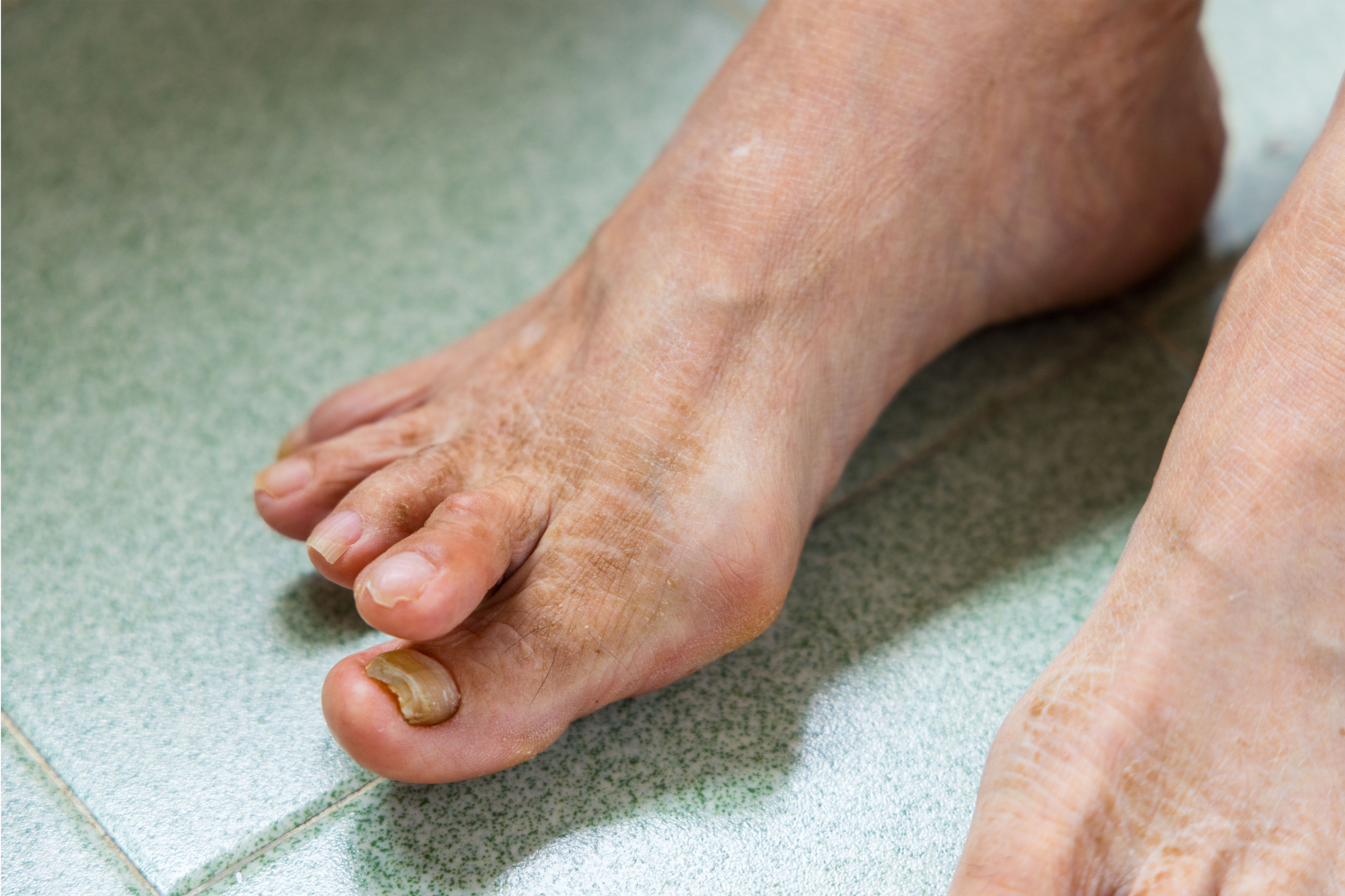 أعراض سعفة القدم