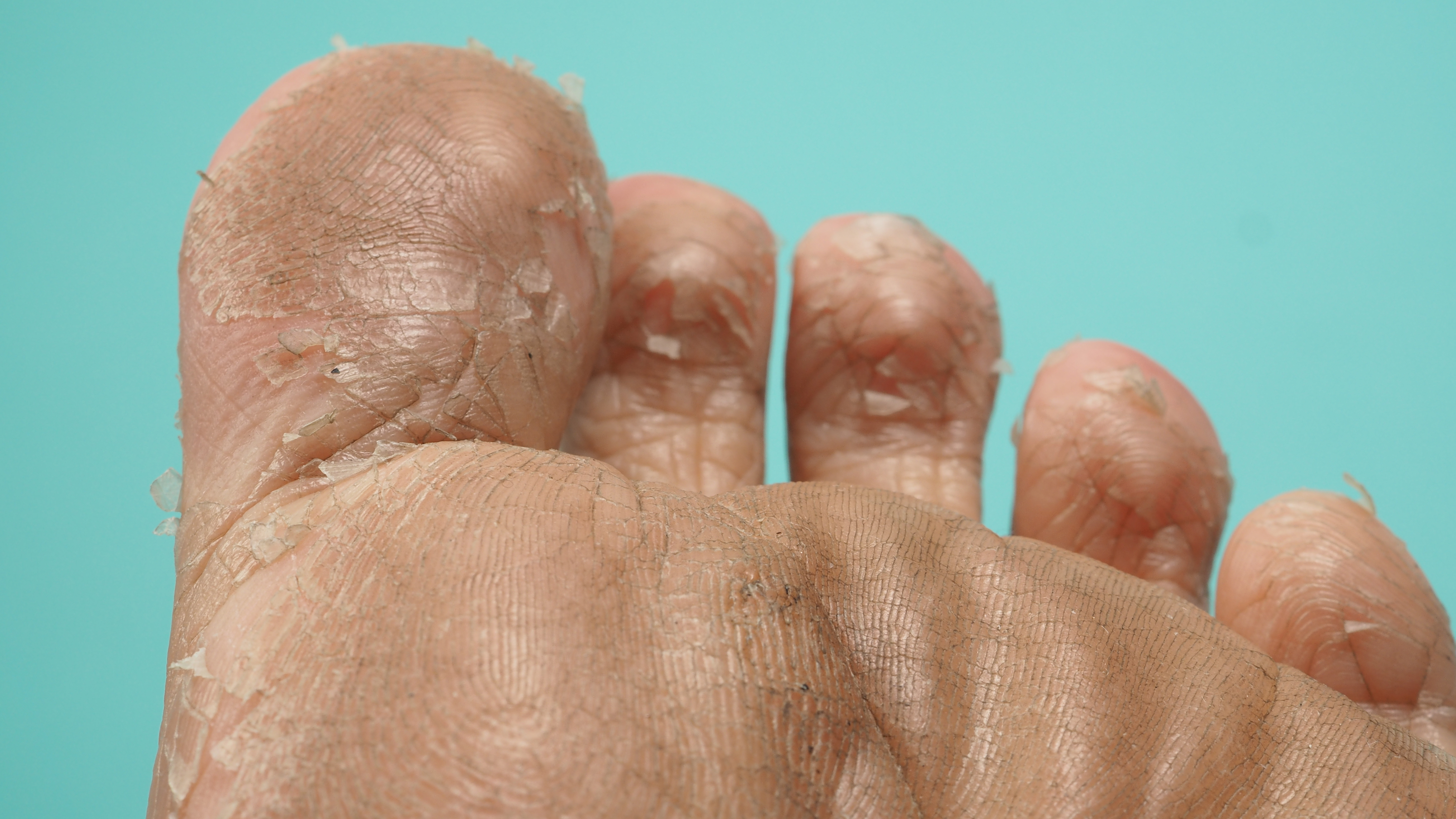 ما هي سعفة القدم؟