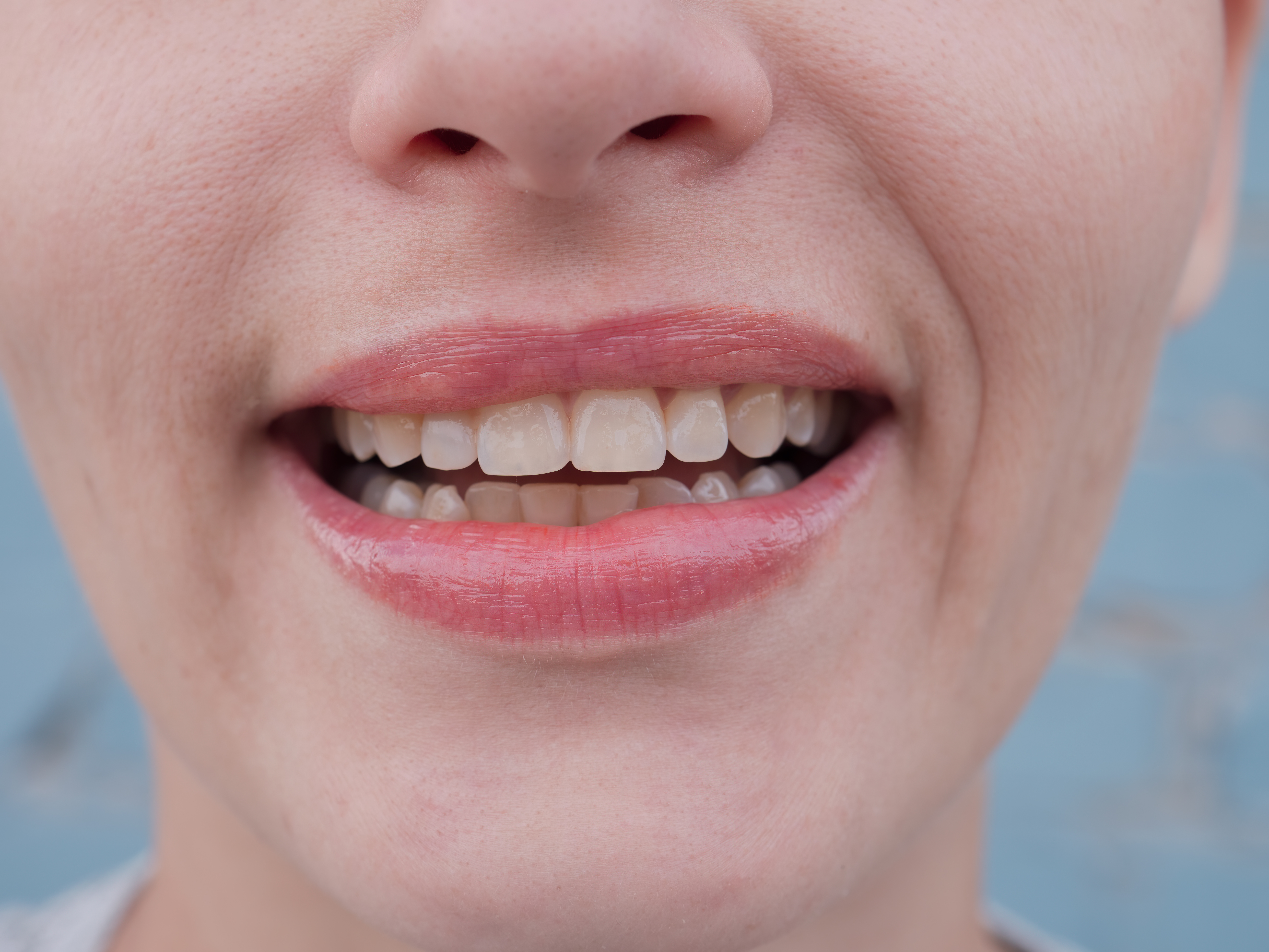 1. زوال التمعدن (بالإنجليزية: Demineralization) في الأسنان