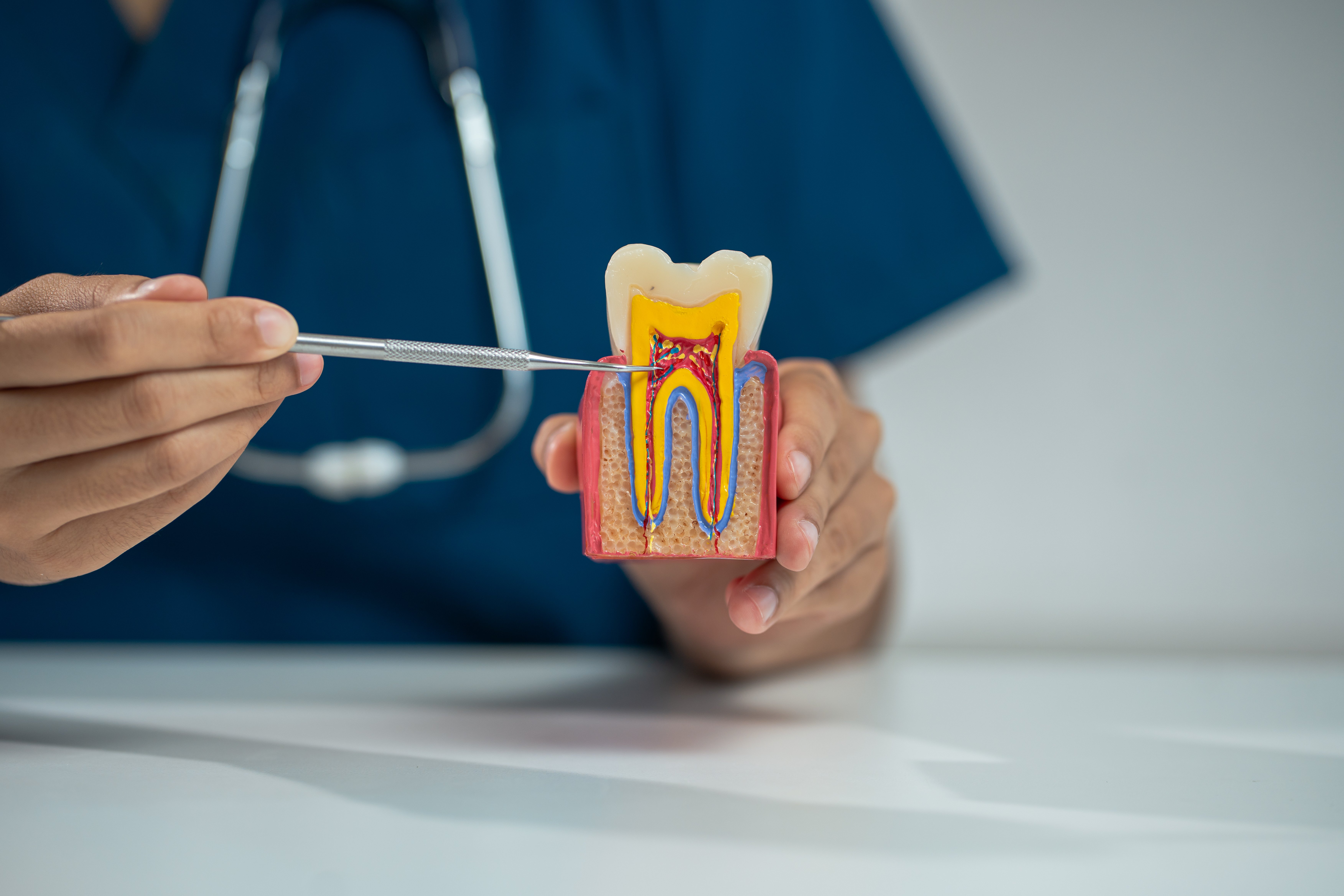 مراحل تسوس الأسنان بالصور: كيف يبدأ؟