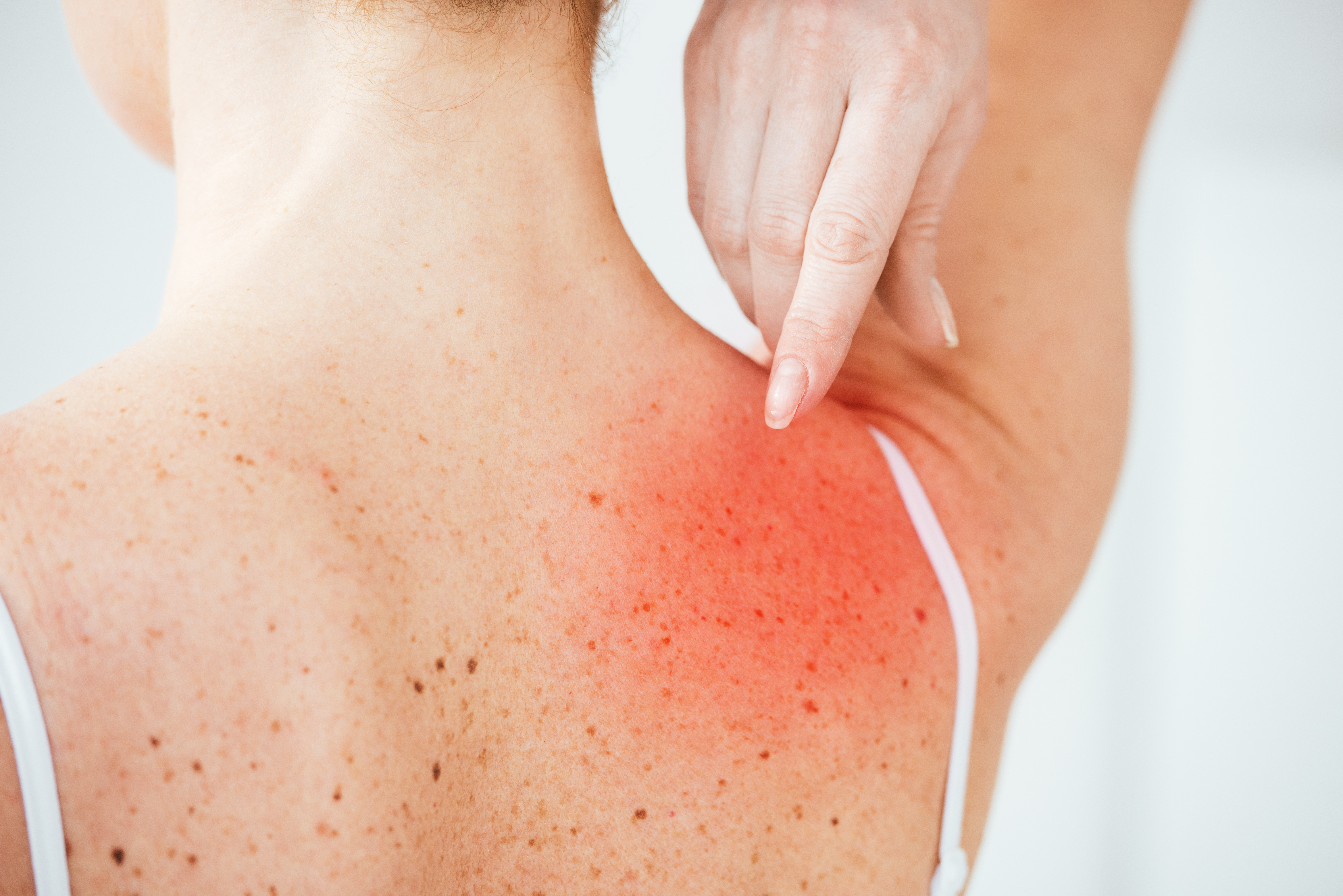 أعراض أخرى لقرصة البق