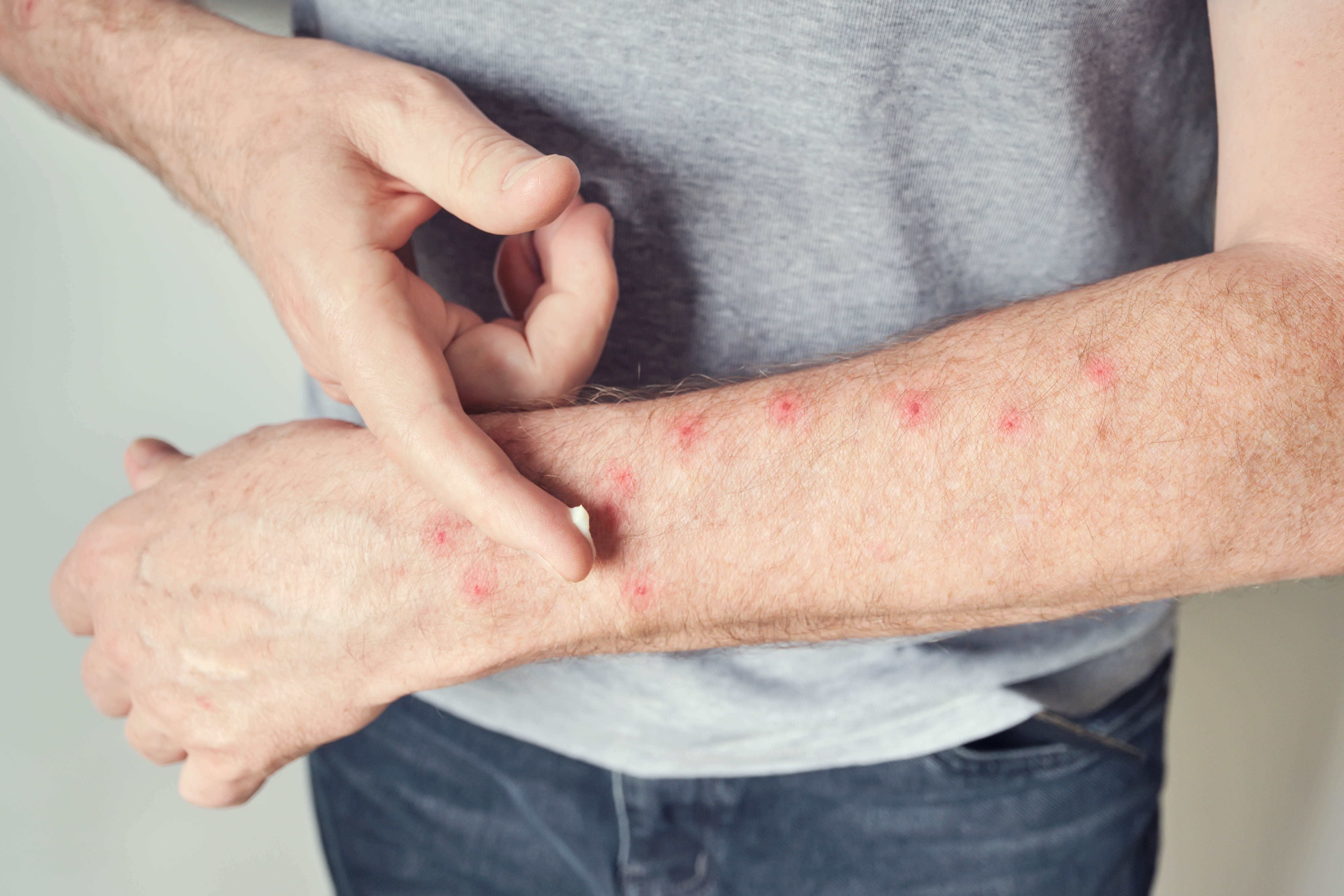 علاجات منزلية لقرصة البق