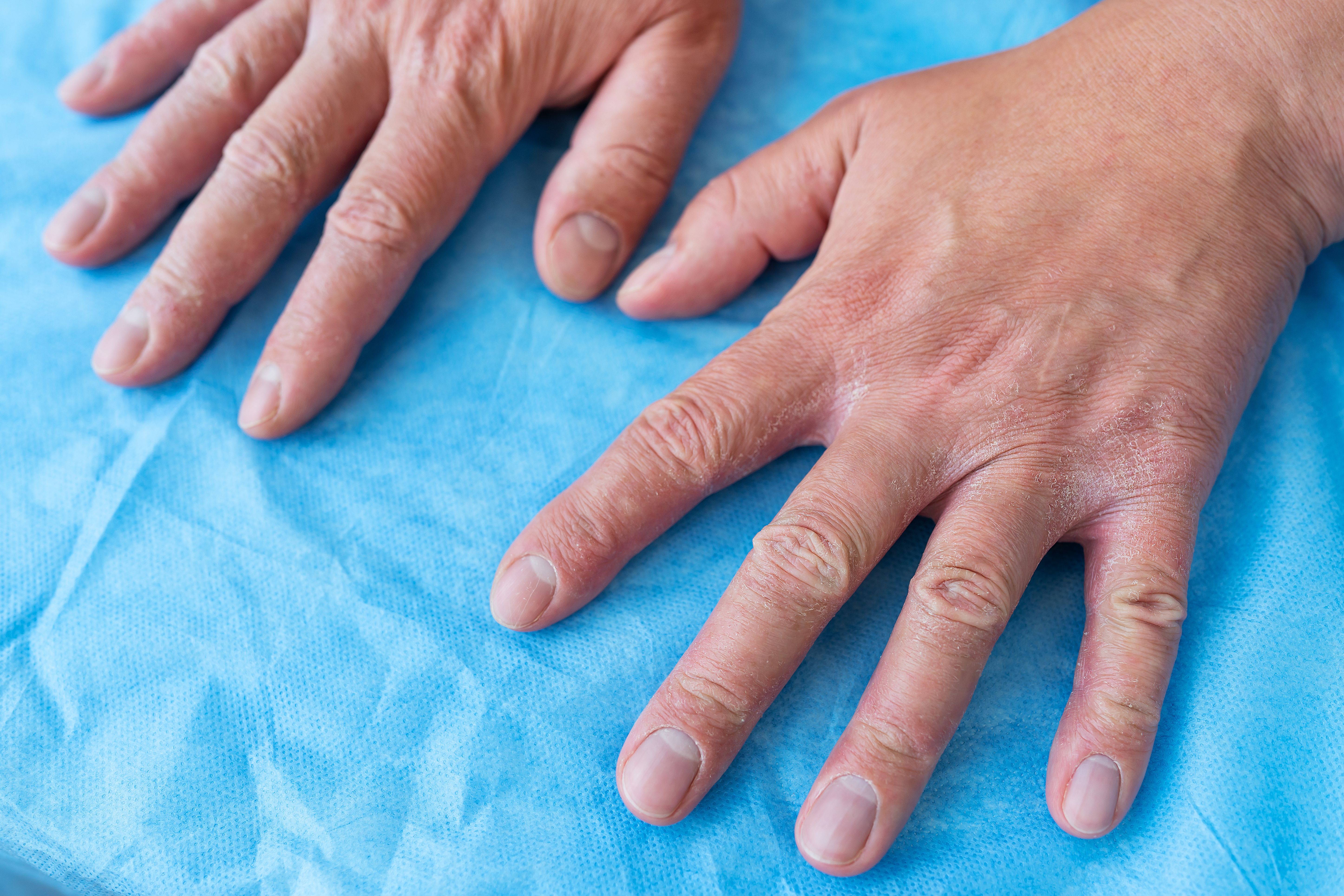 تصلب الجلد بالصور: الأنواع والأعراض وطرق العلاج