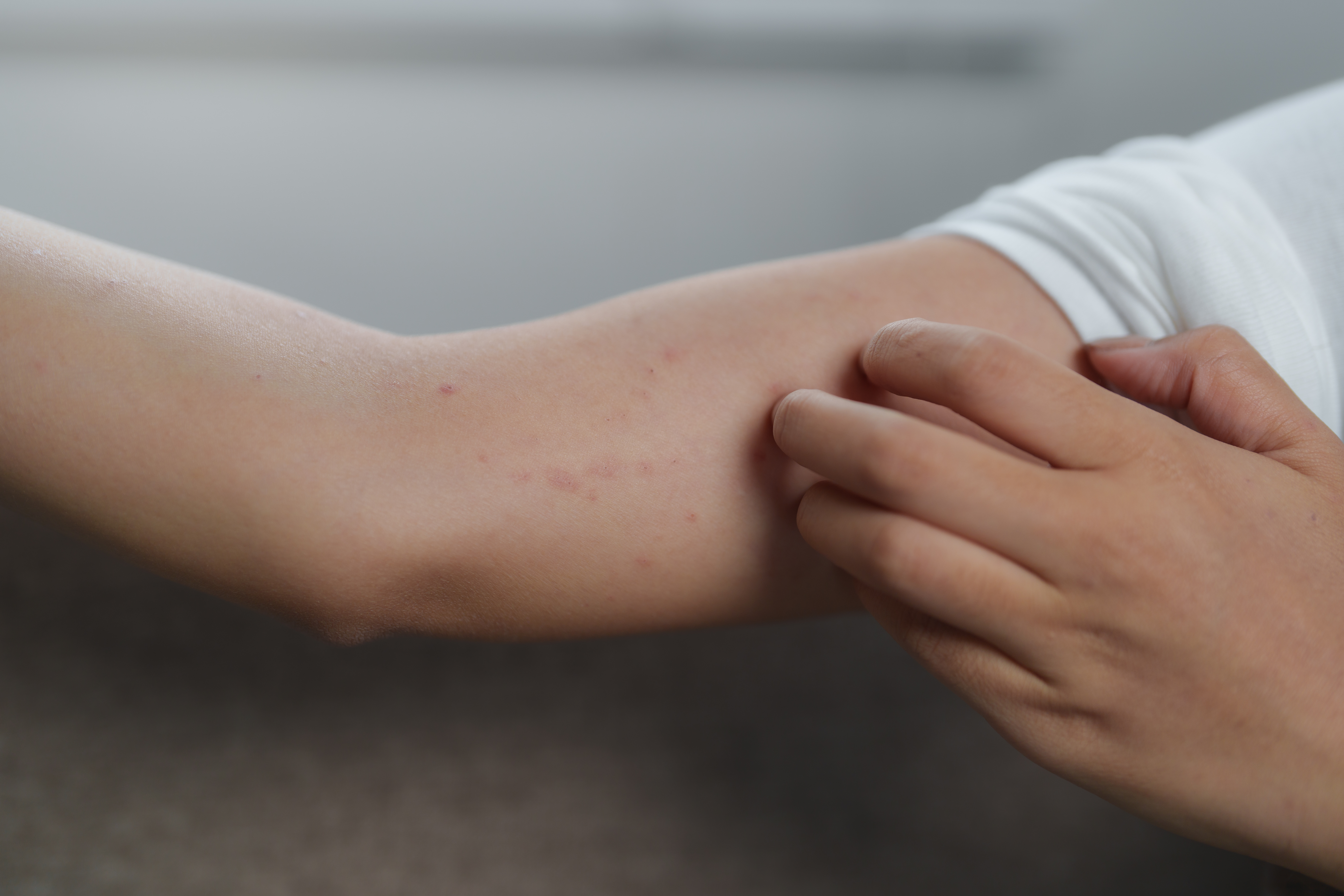 الجرب بالصور: الأسباب، والأعراض وطرق العلاج!