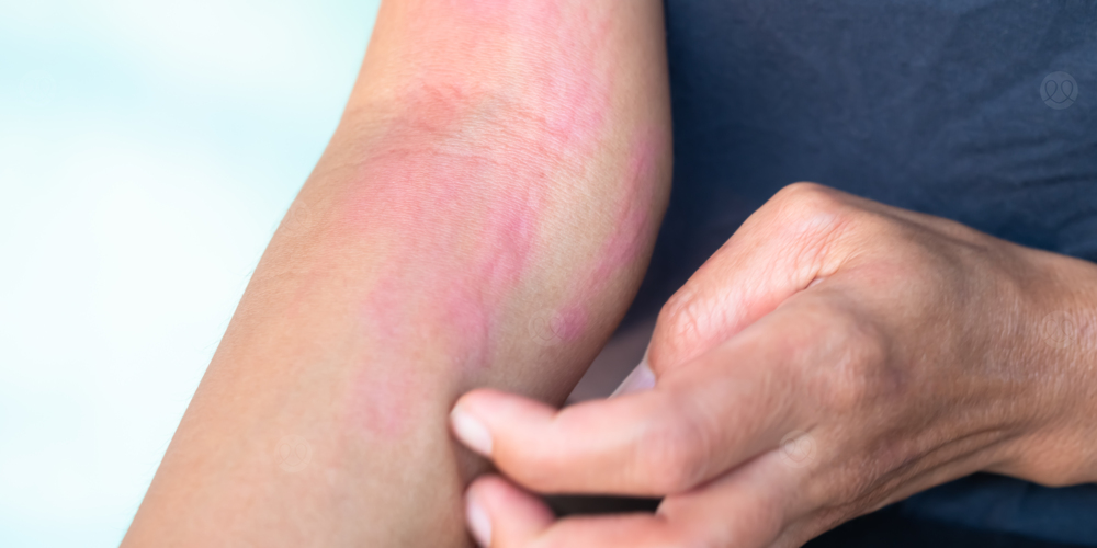 حساسية الجلد