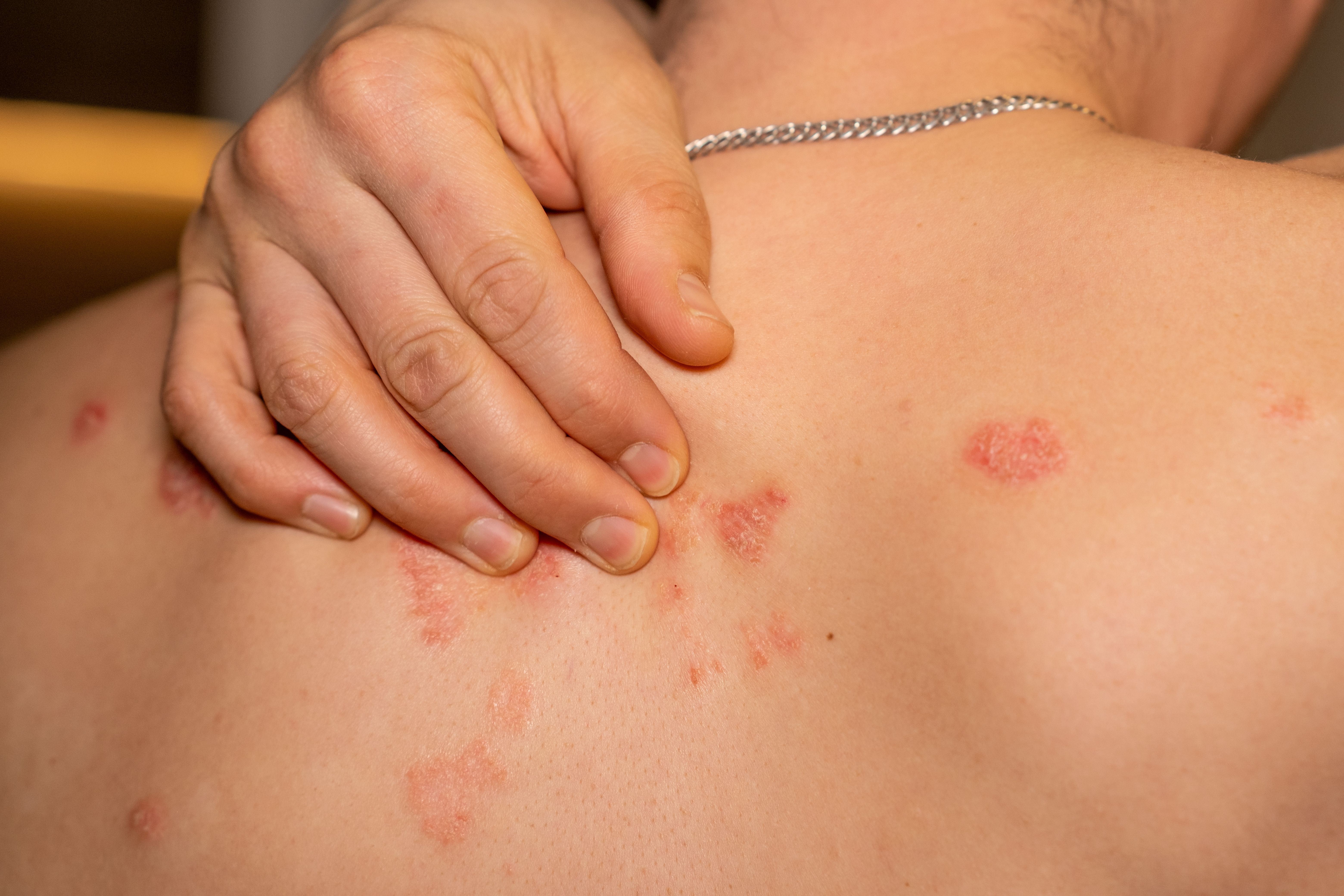 ما هو الجرب؟