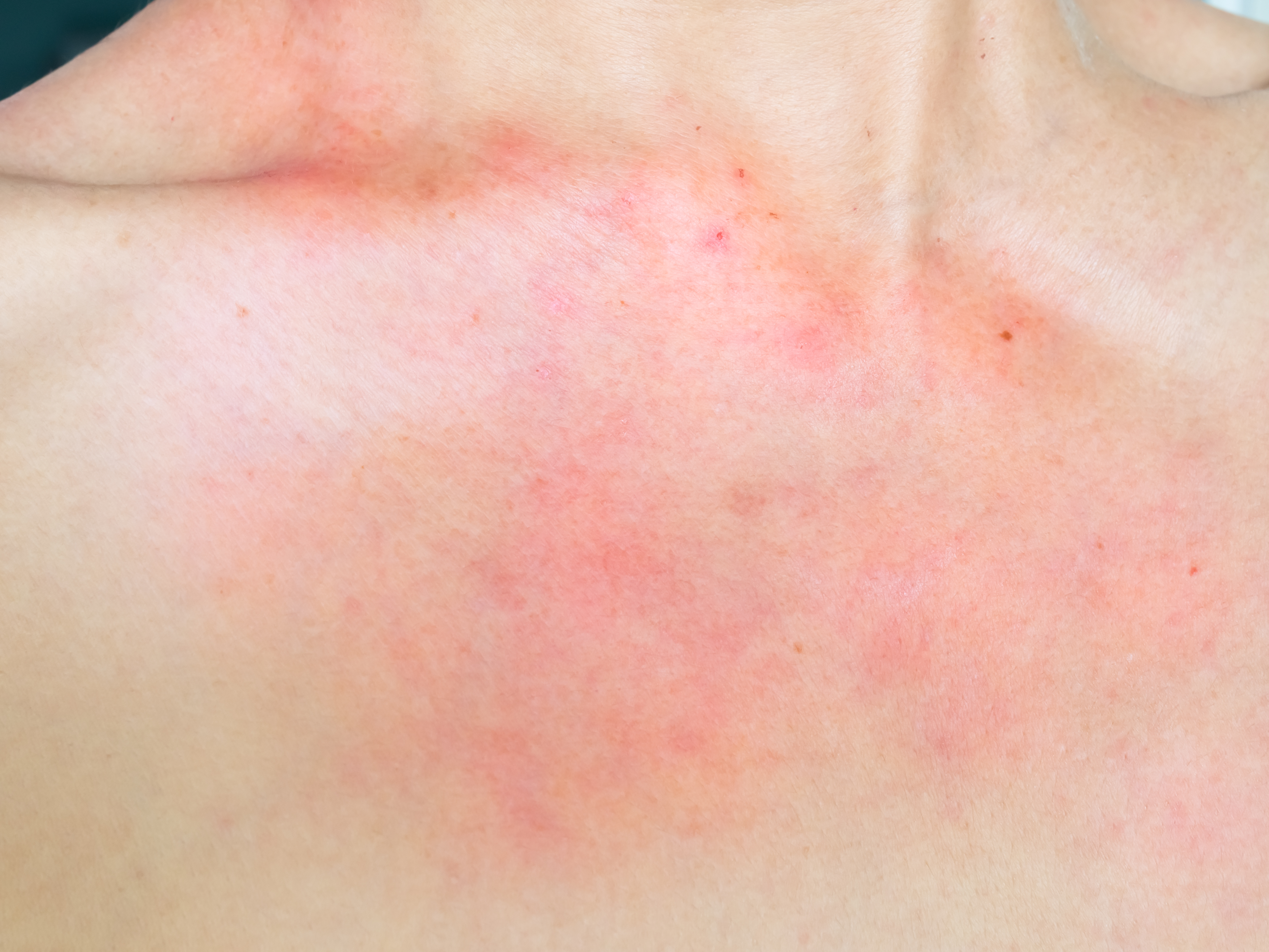 5. مدة استمرار الأعراض