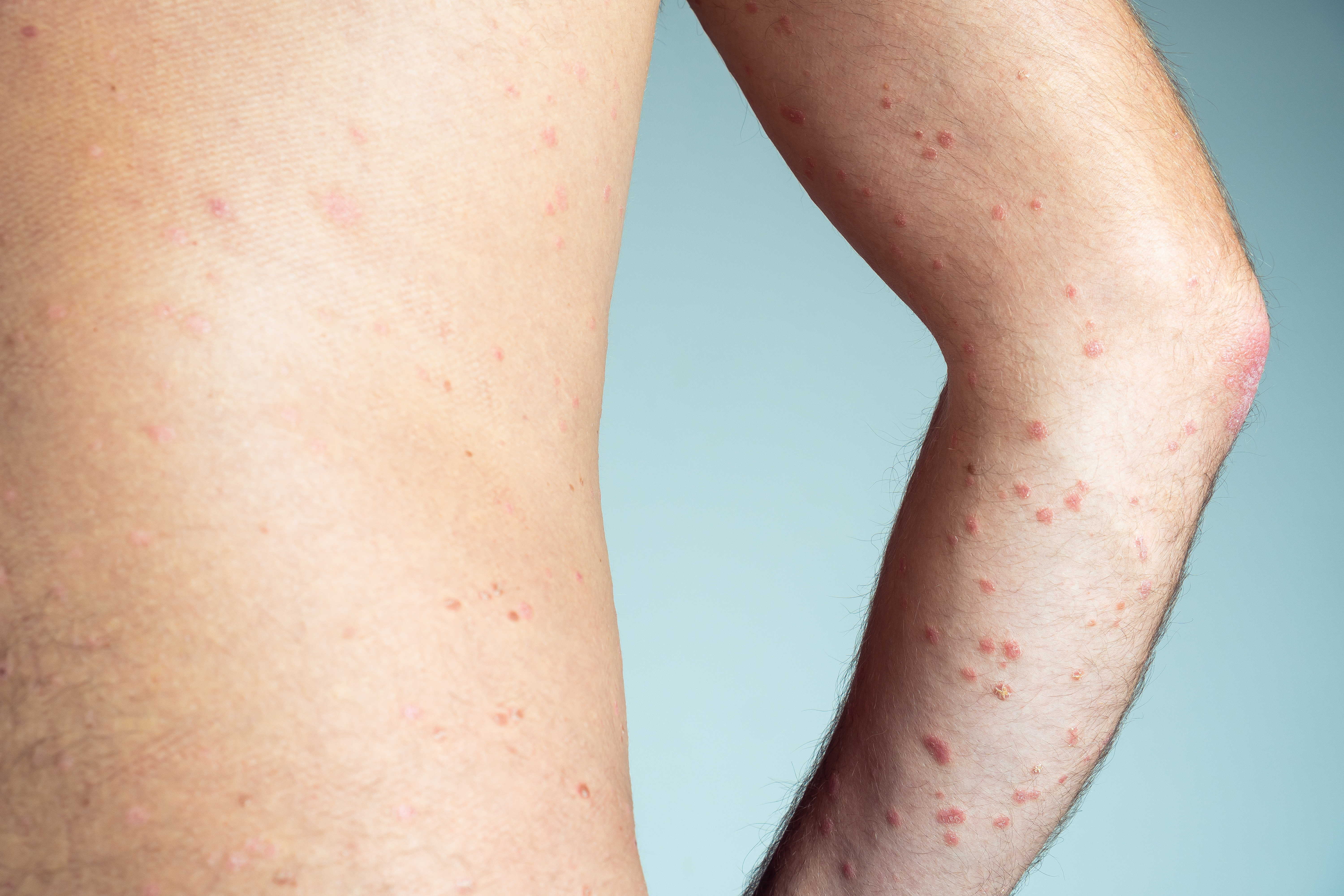 أين تظهر حبوب الجرب؟