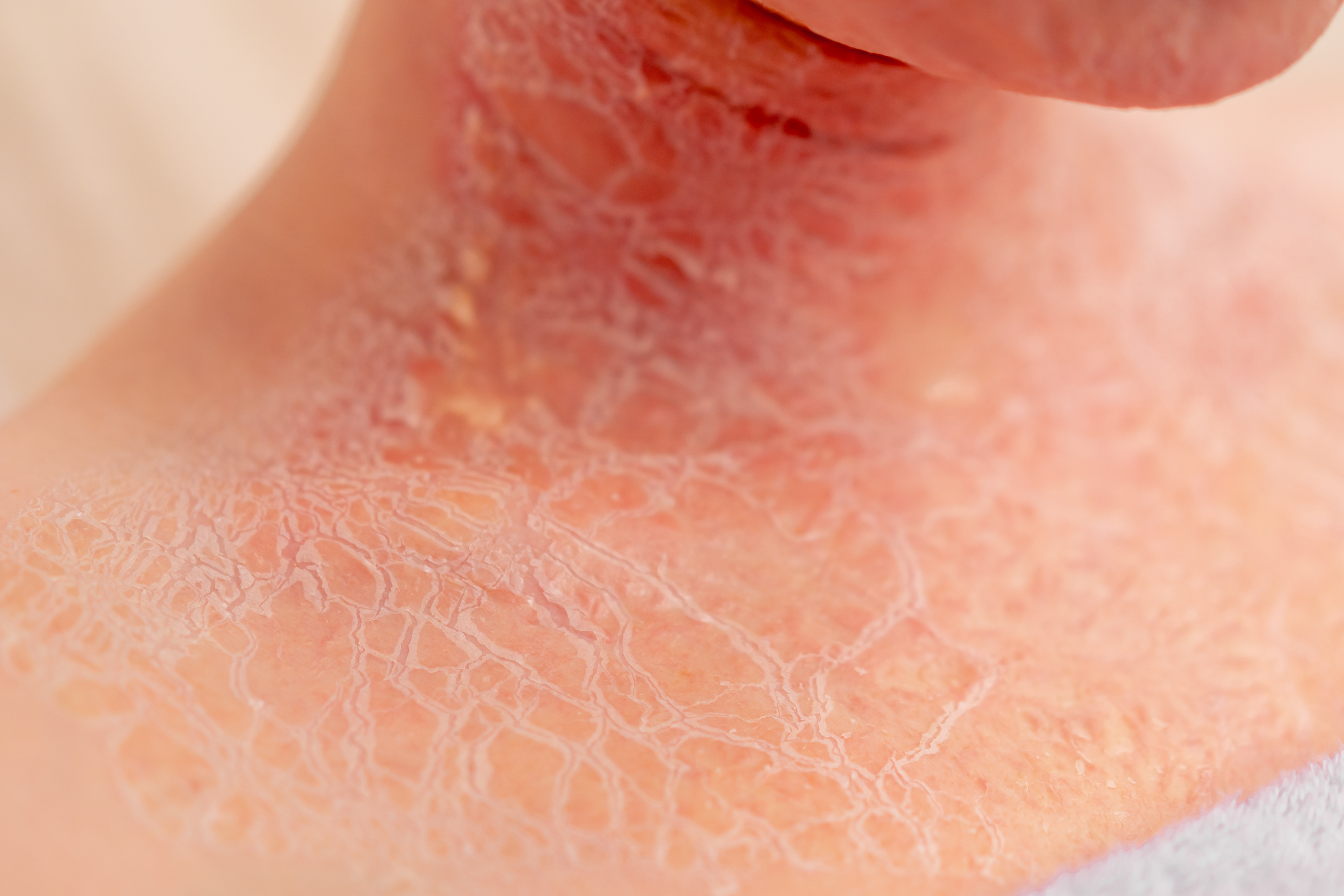 أعراض جلد السمكة