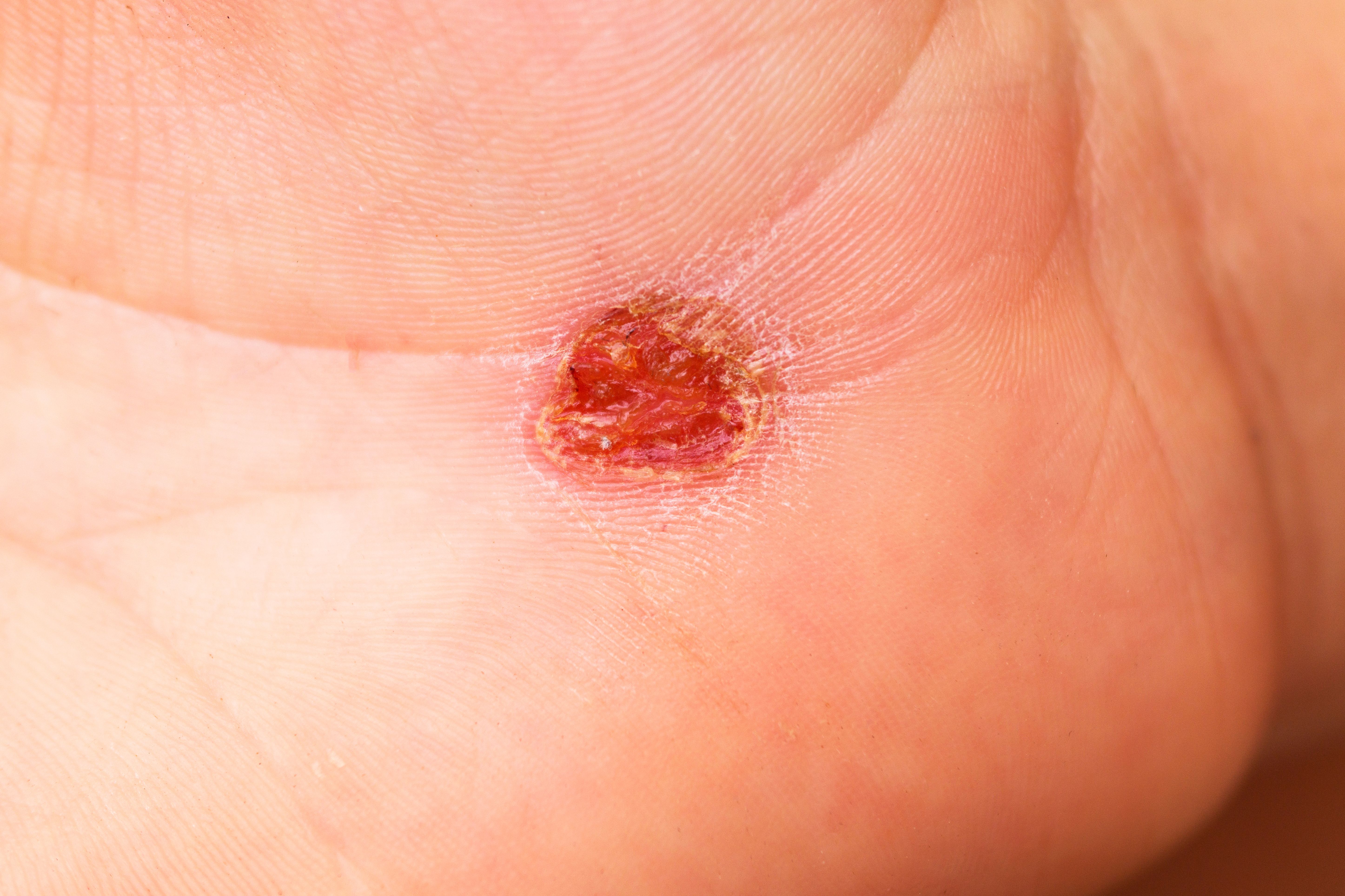 1. اللشمانيا الجلدية