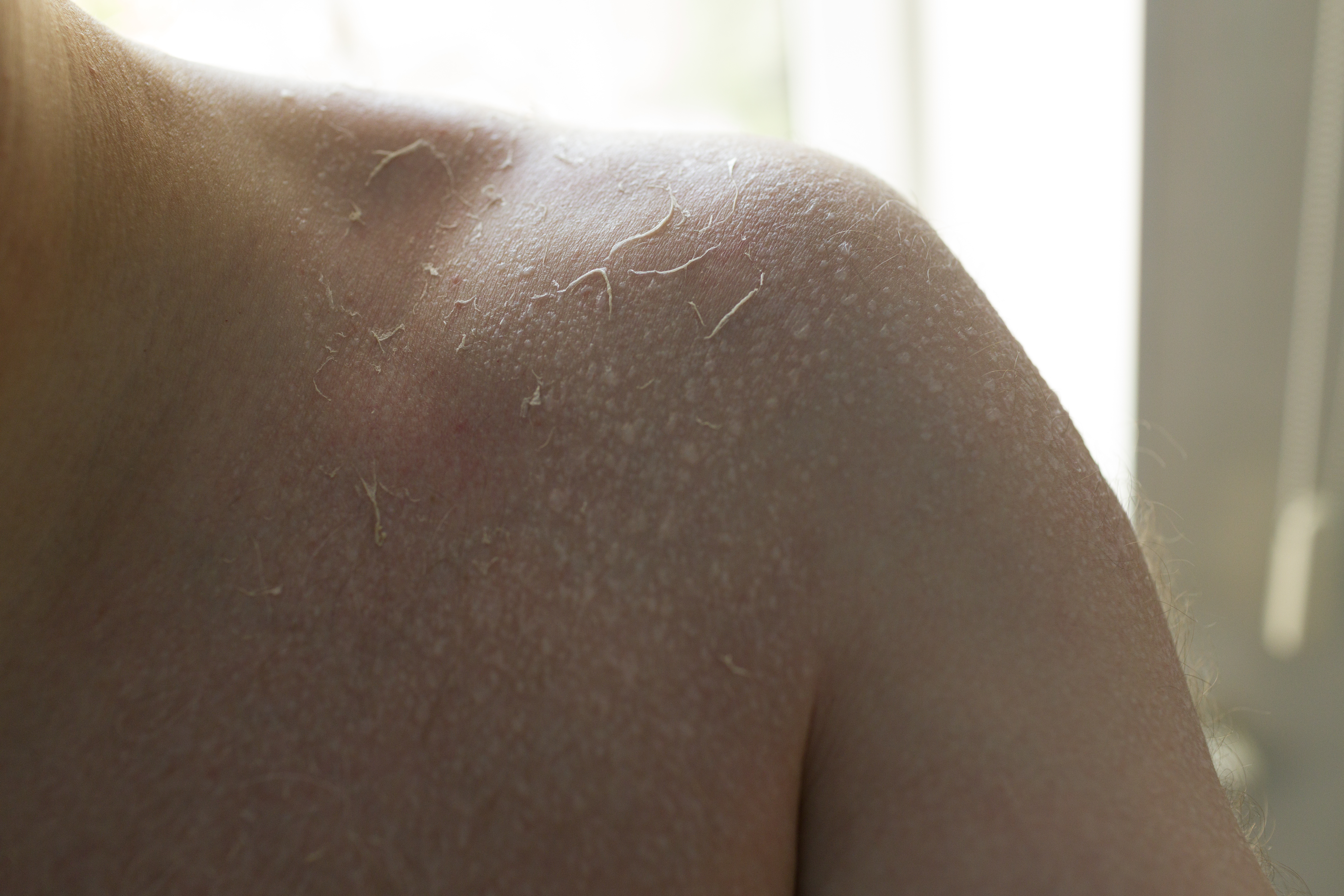 ما هو مرض جلد السمكة؟