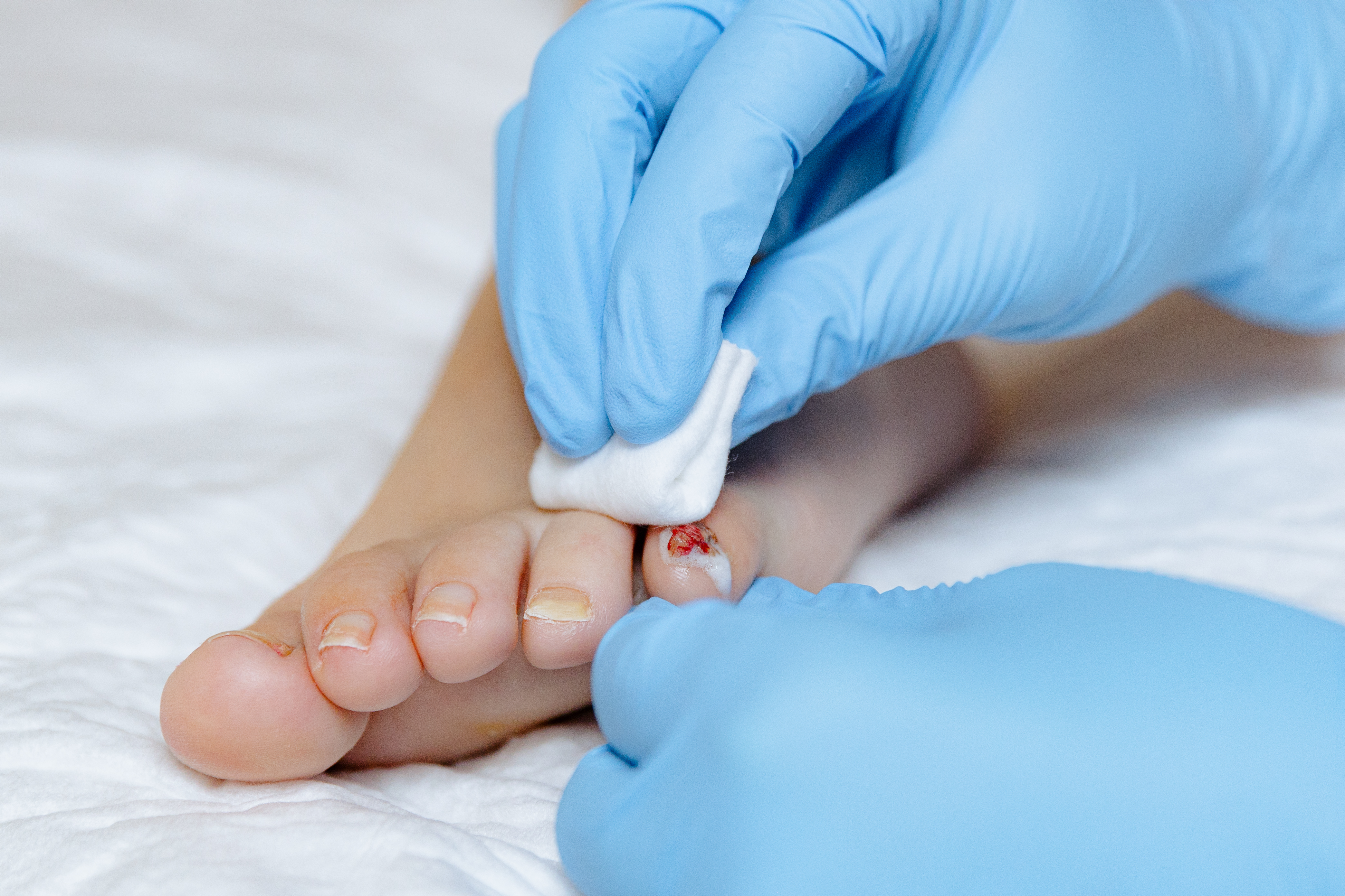 علاج القدم السكرية