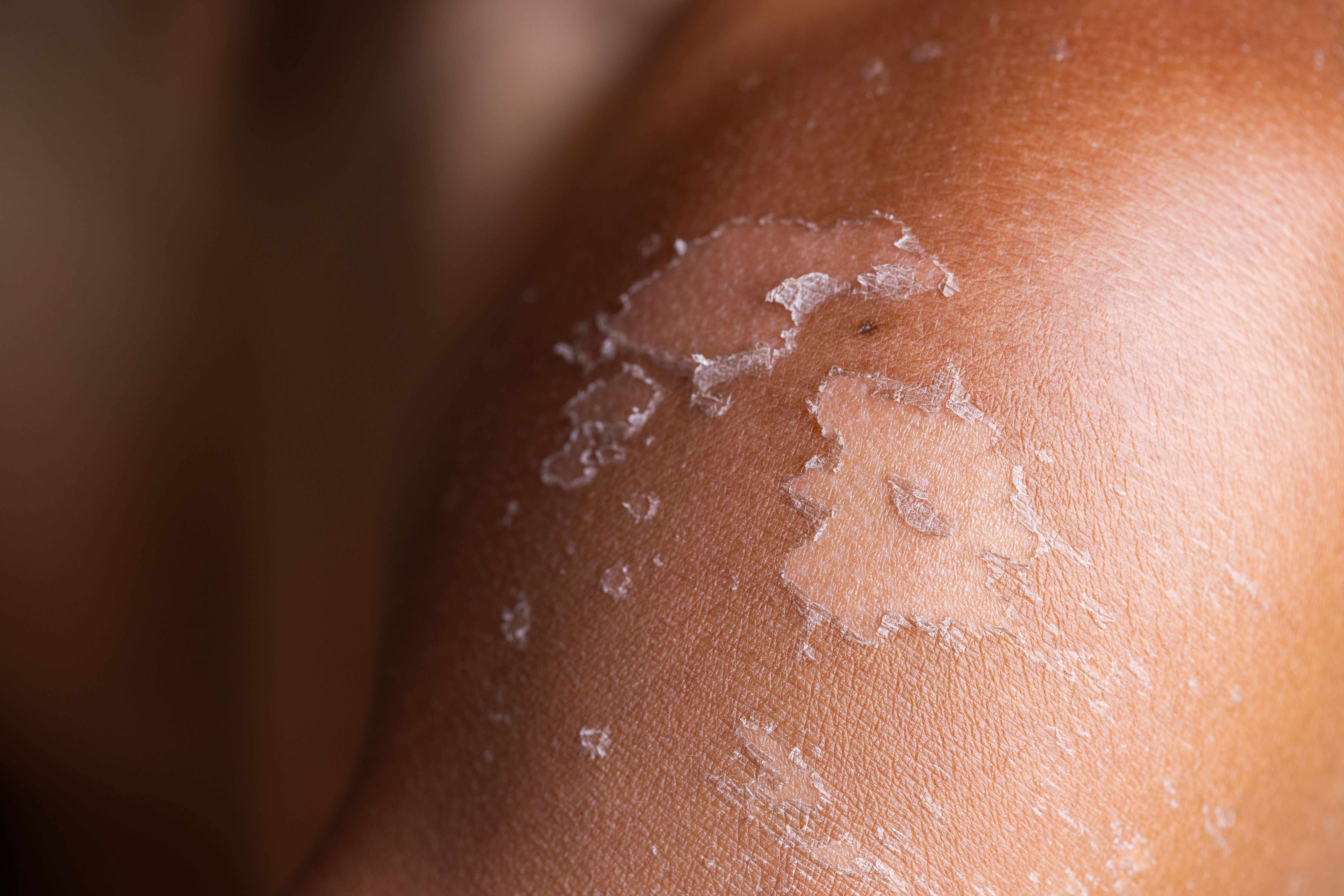 3. جفاف الجلد وتشققه