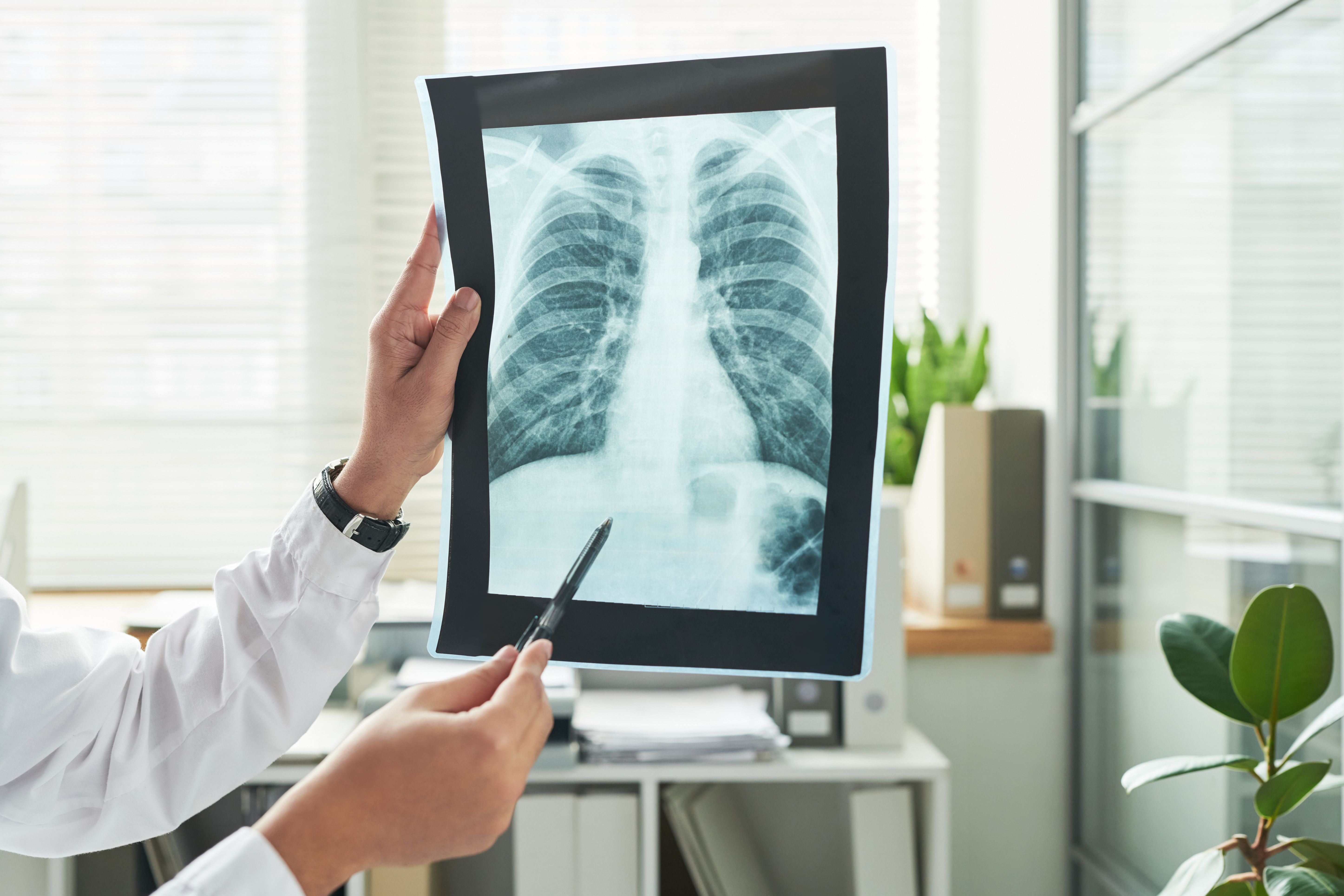 تشخيص سرطان الرئة