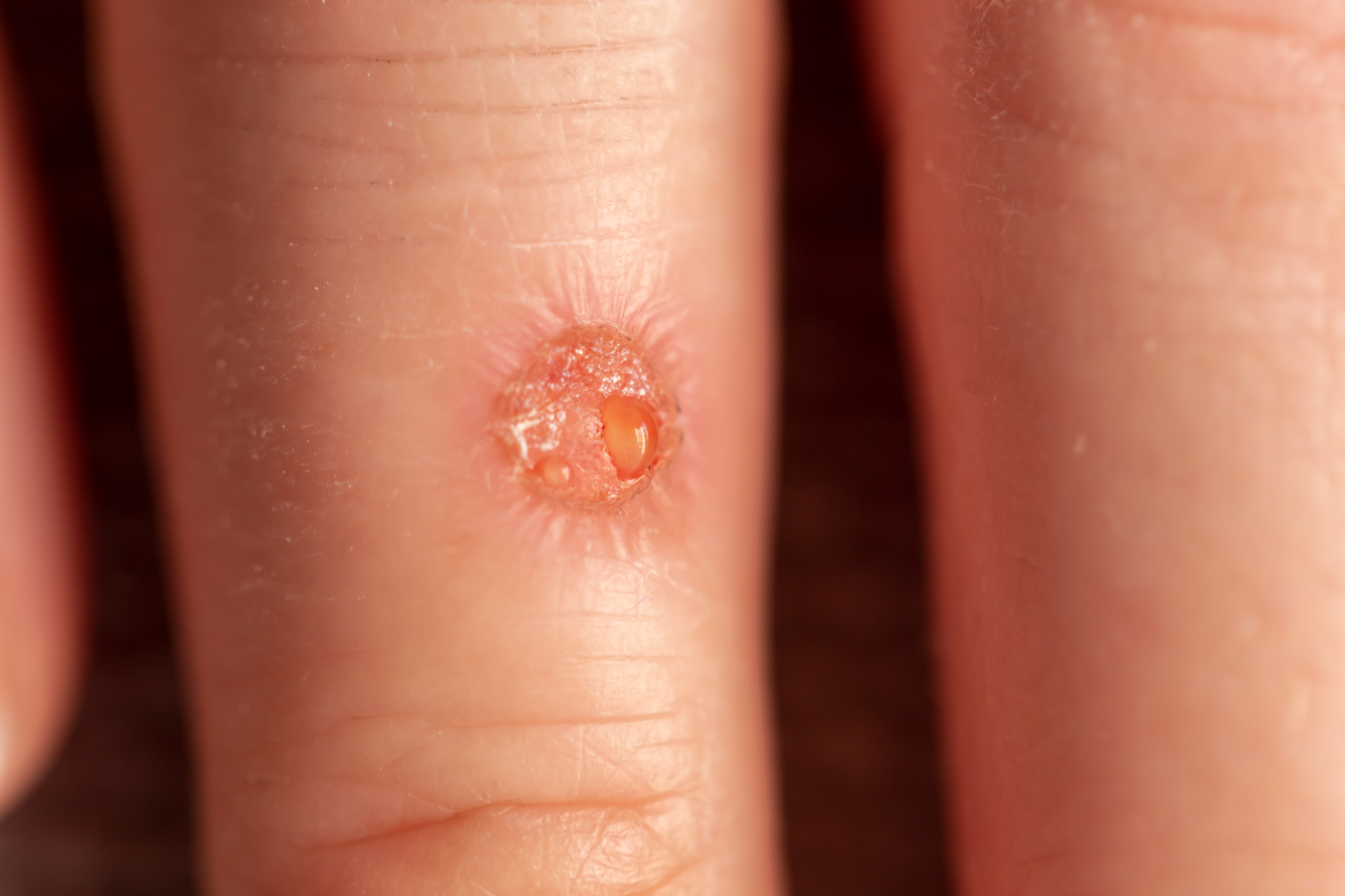 شكل قرحة اللشمانيا في المراحل المتقدمة