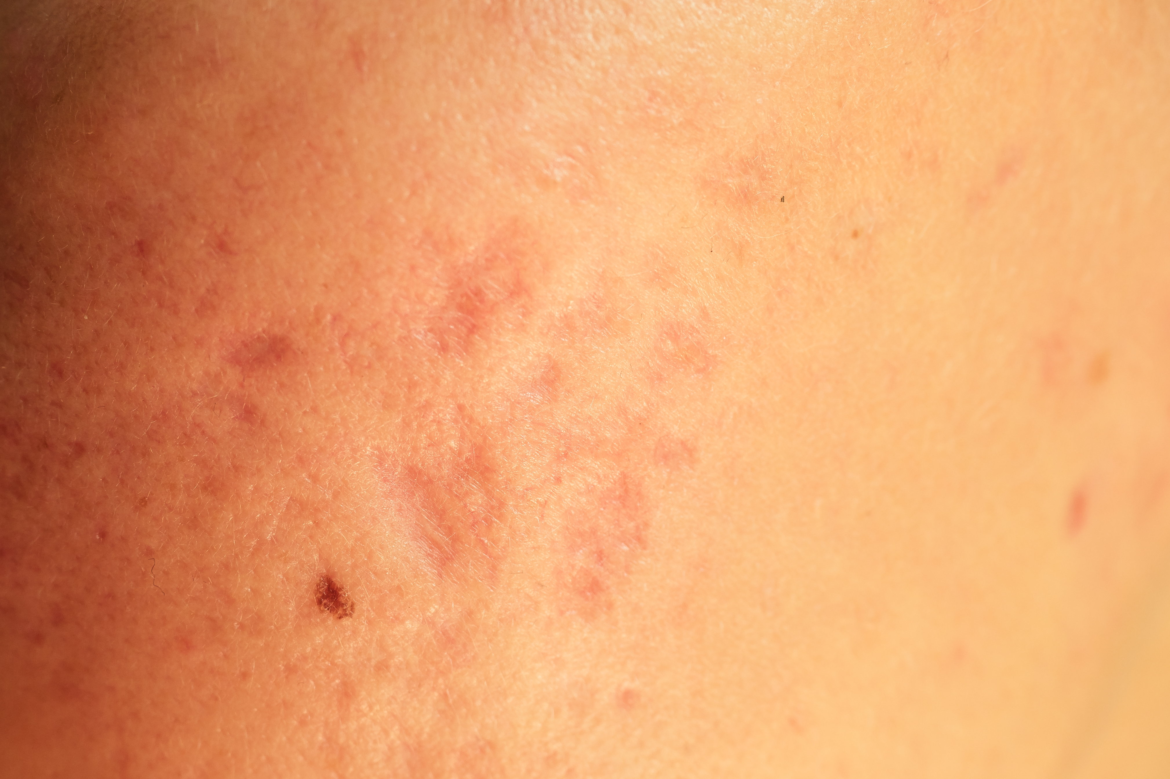 شكل حبة اللشمانيا بعد شفائها