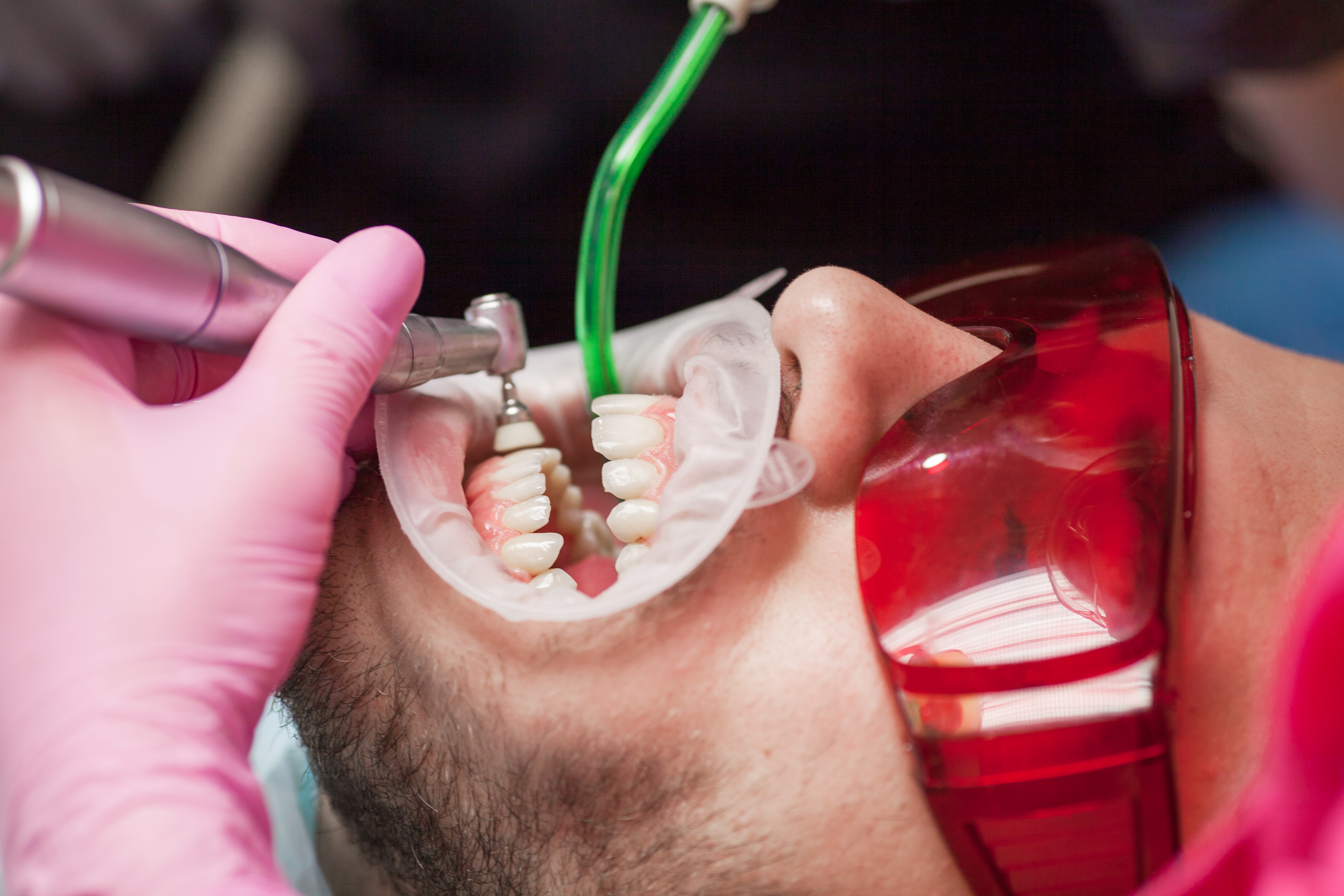 متى يجب الخضوع لزراعة الأسنان؟