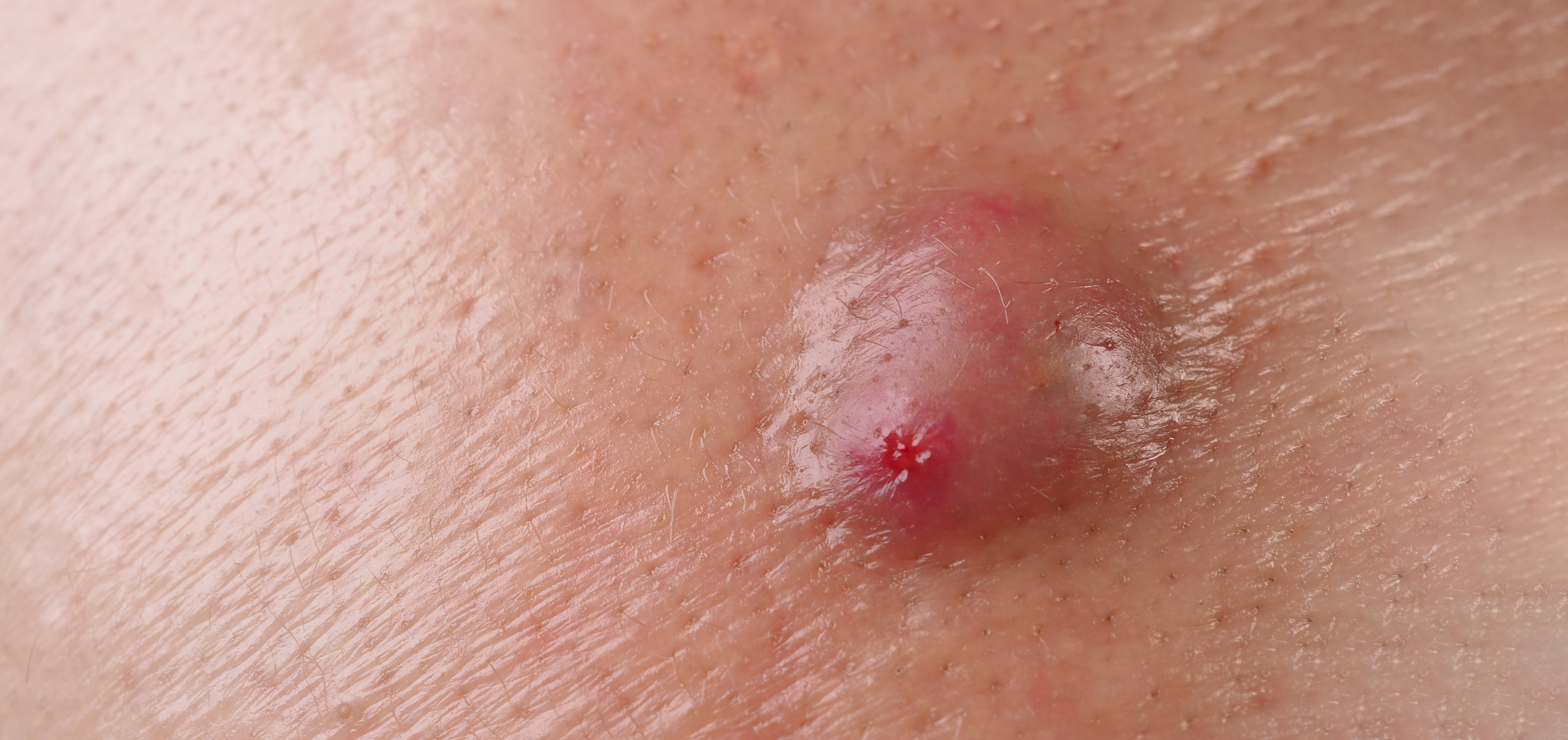 شكل حبة اللشمانيا في المراحل المتقدمة