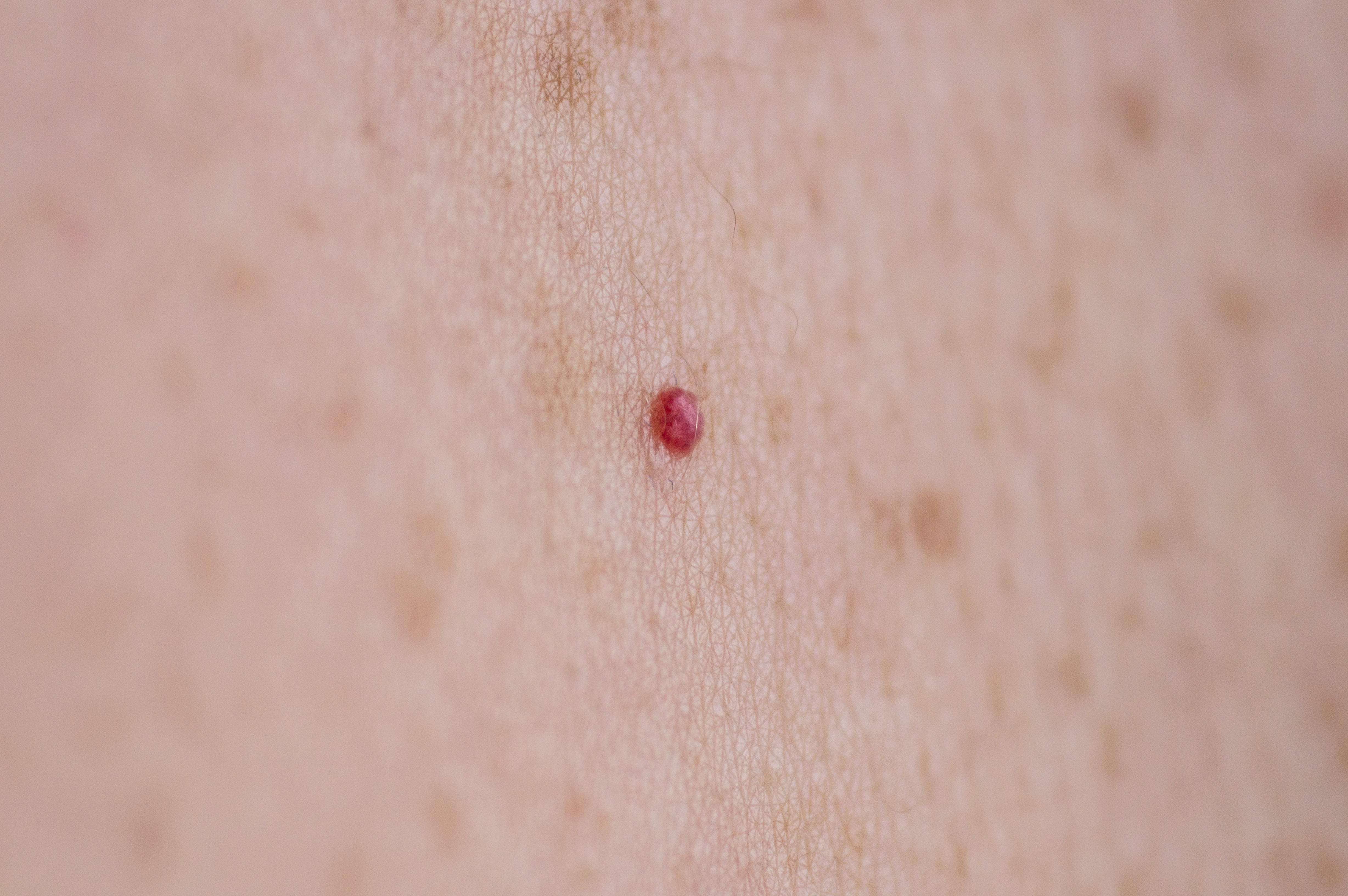 شكل حبة اللشمانيا في البداية