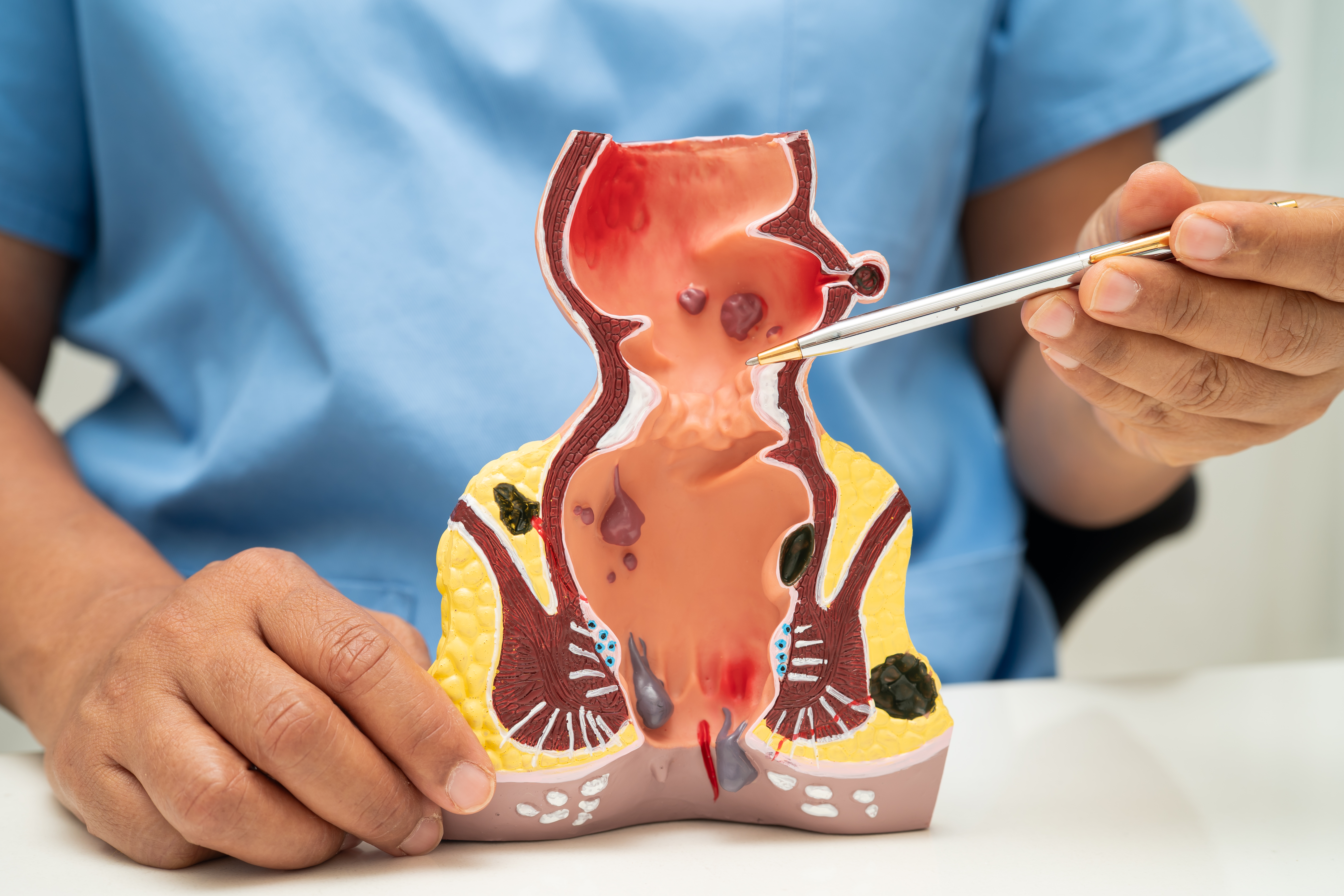 أعراض البواسير بالصور: علامات شائعة ومتى تكون خطيرة؟