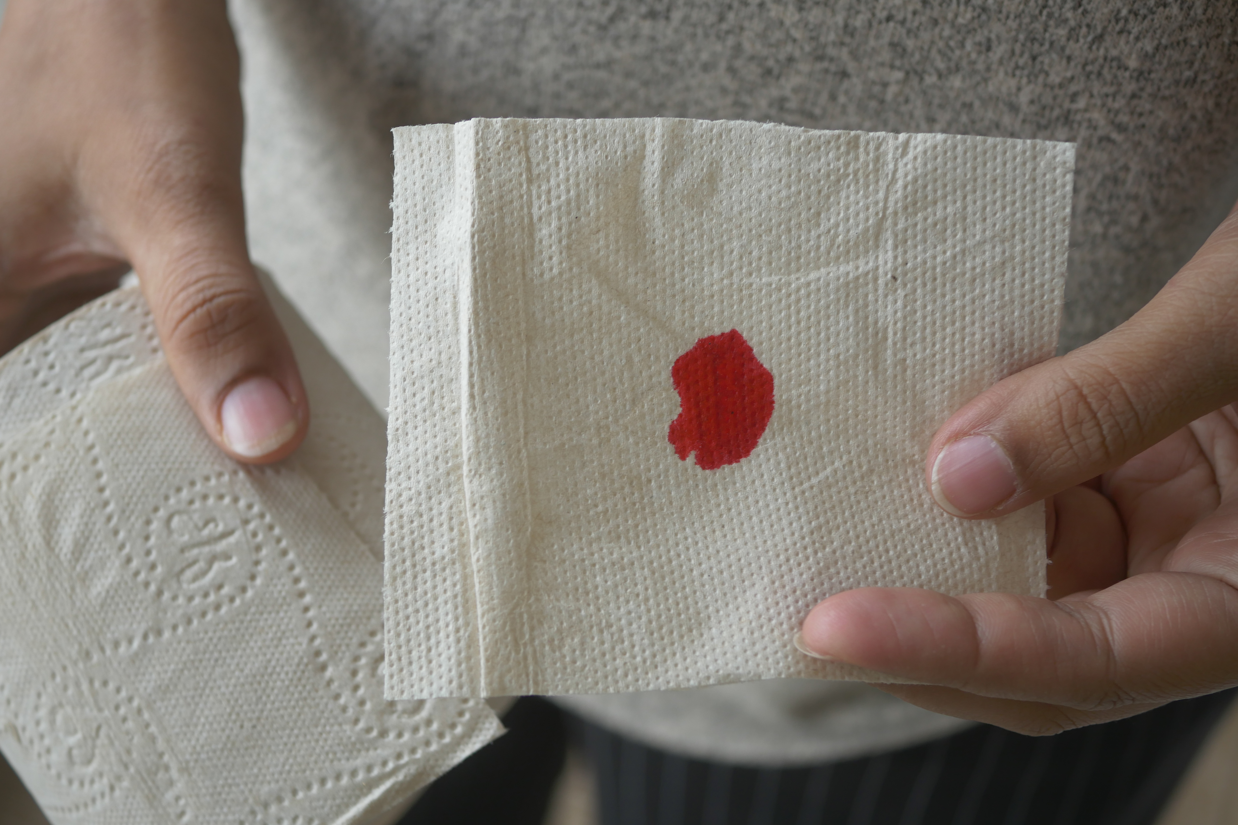 1. النزيف الشرجي