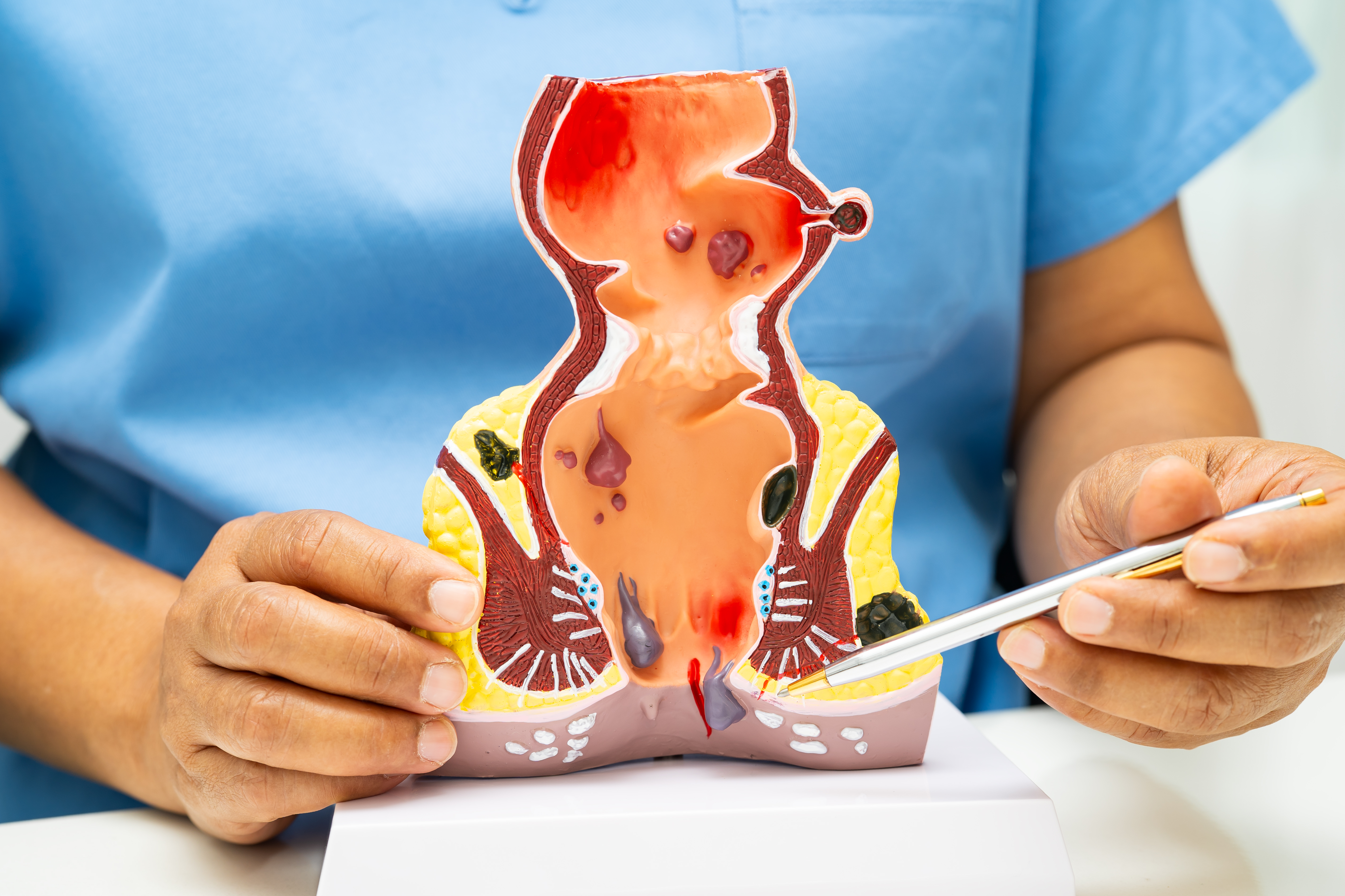 ما هي البواسير؟