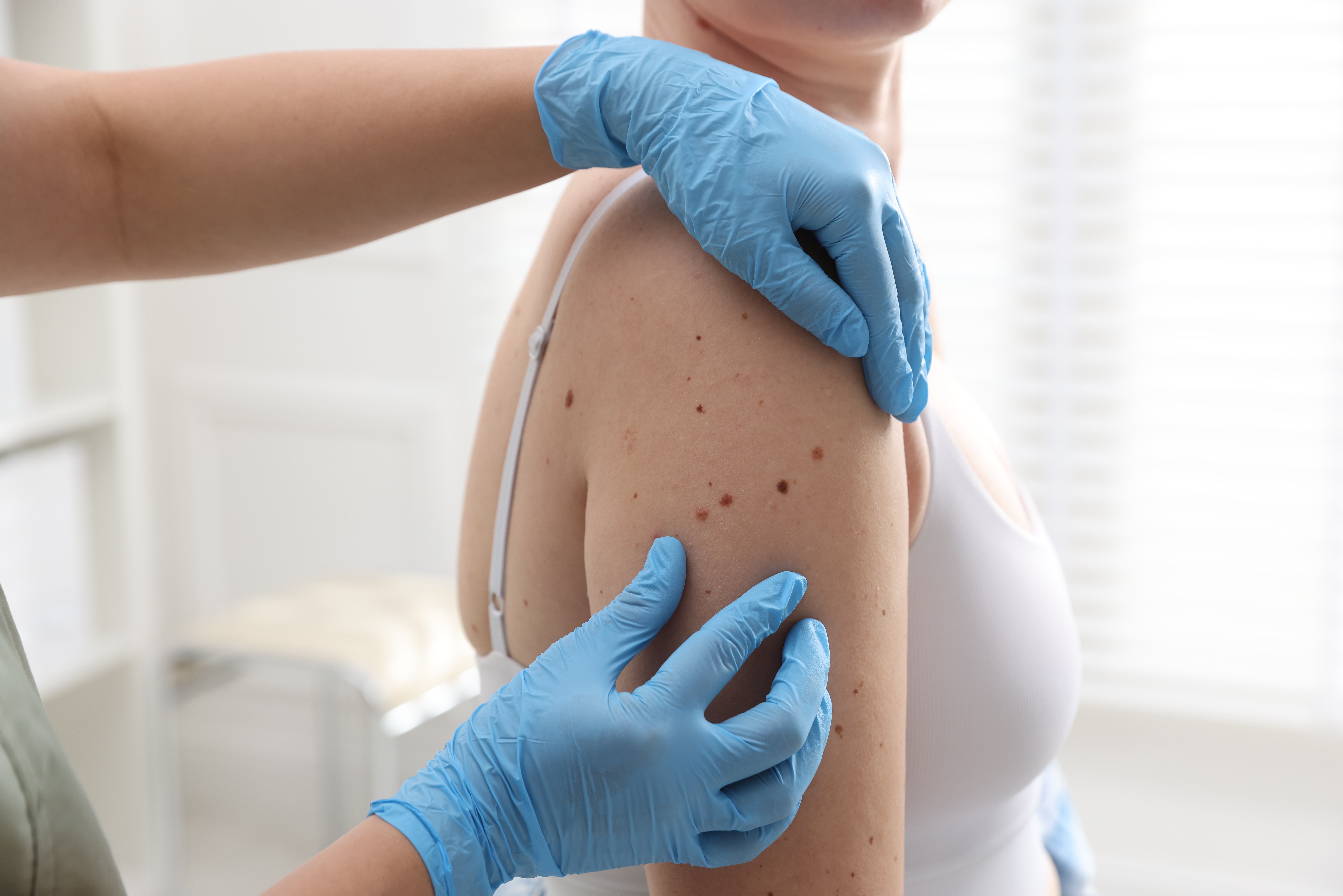 تشخيص جدري القردة