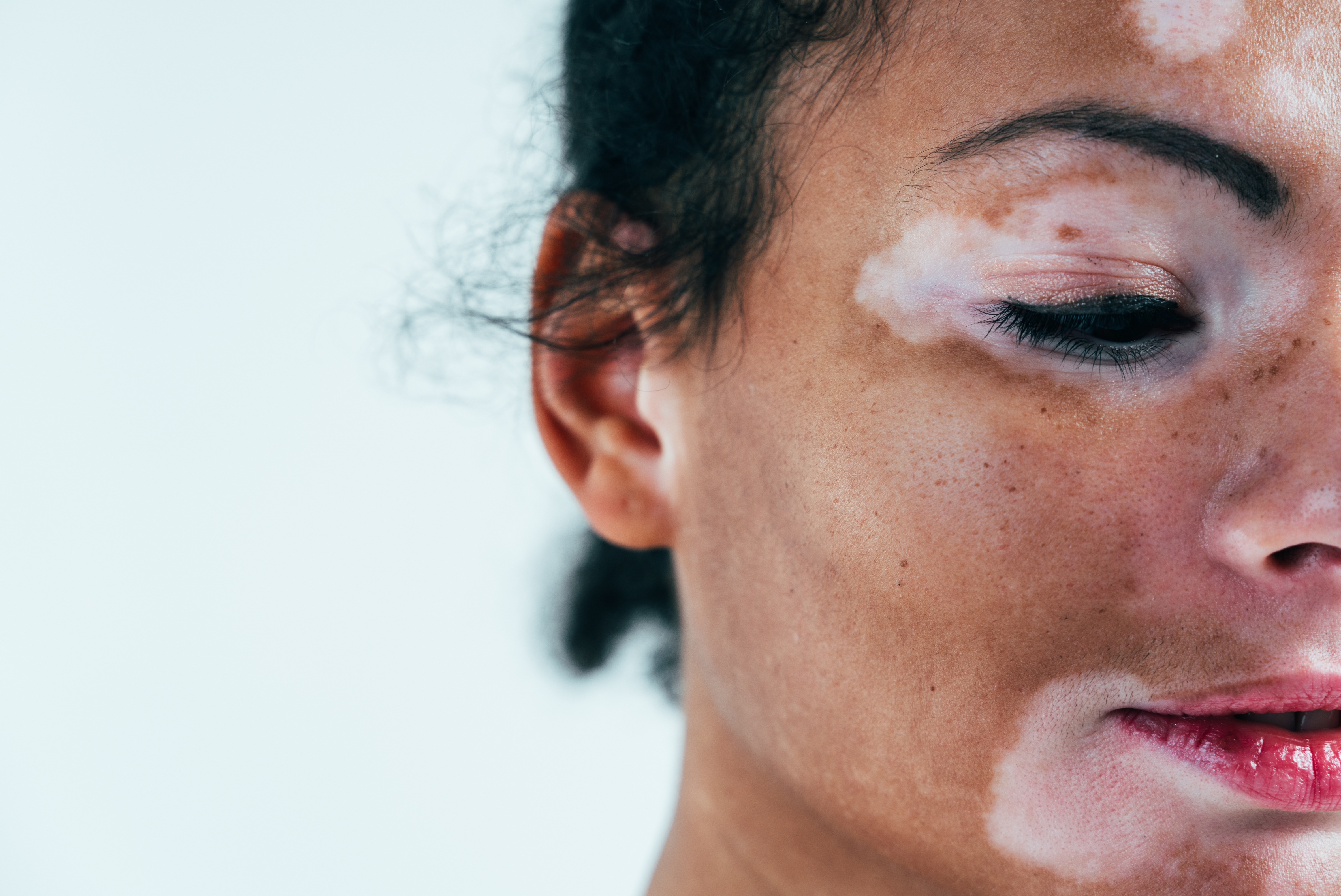 1. البهاق يُسبب بقعًا بيضاء في مناطق محددة