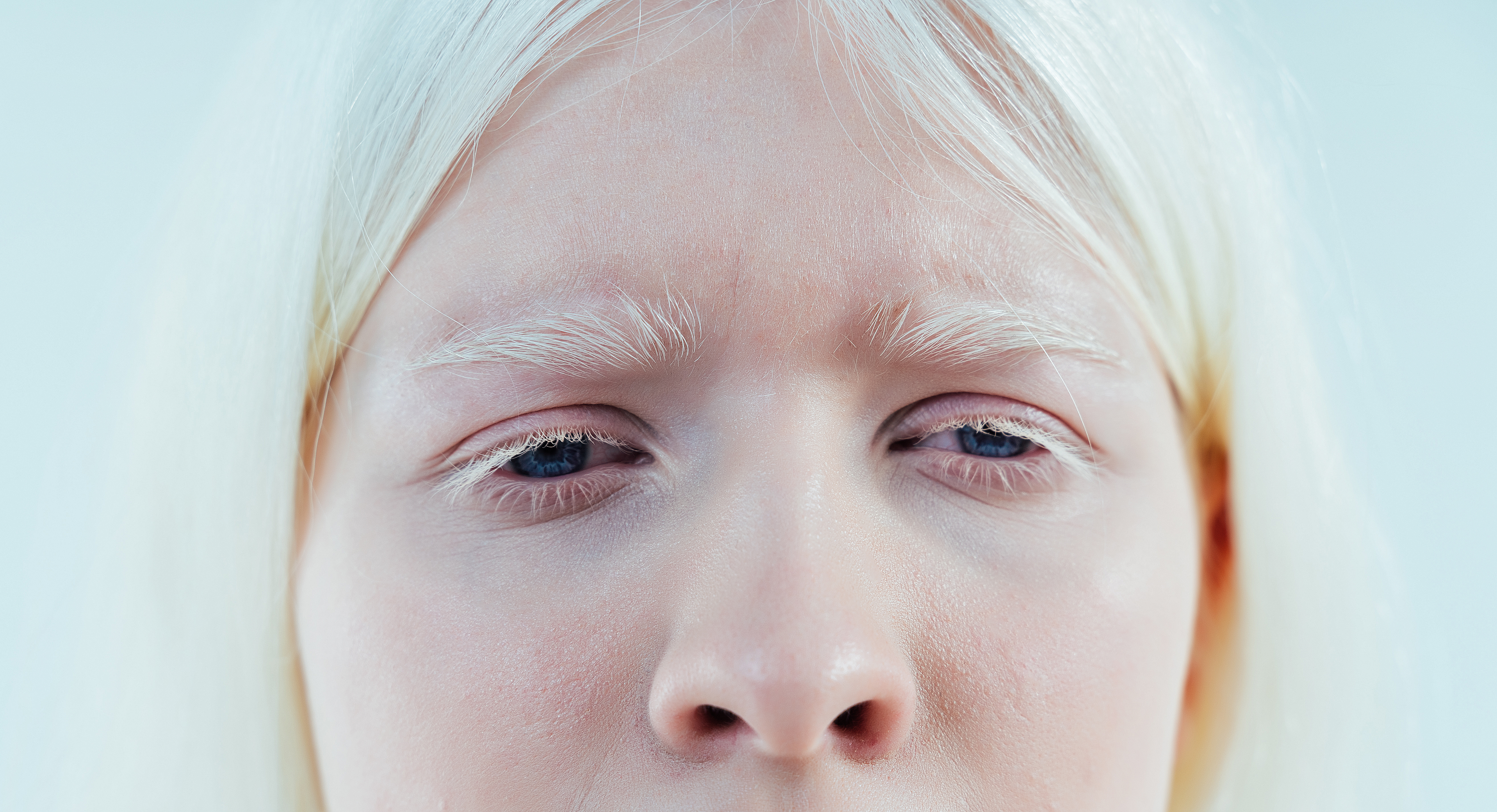 2. البرص قد يؤثّر على الرؤية