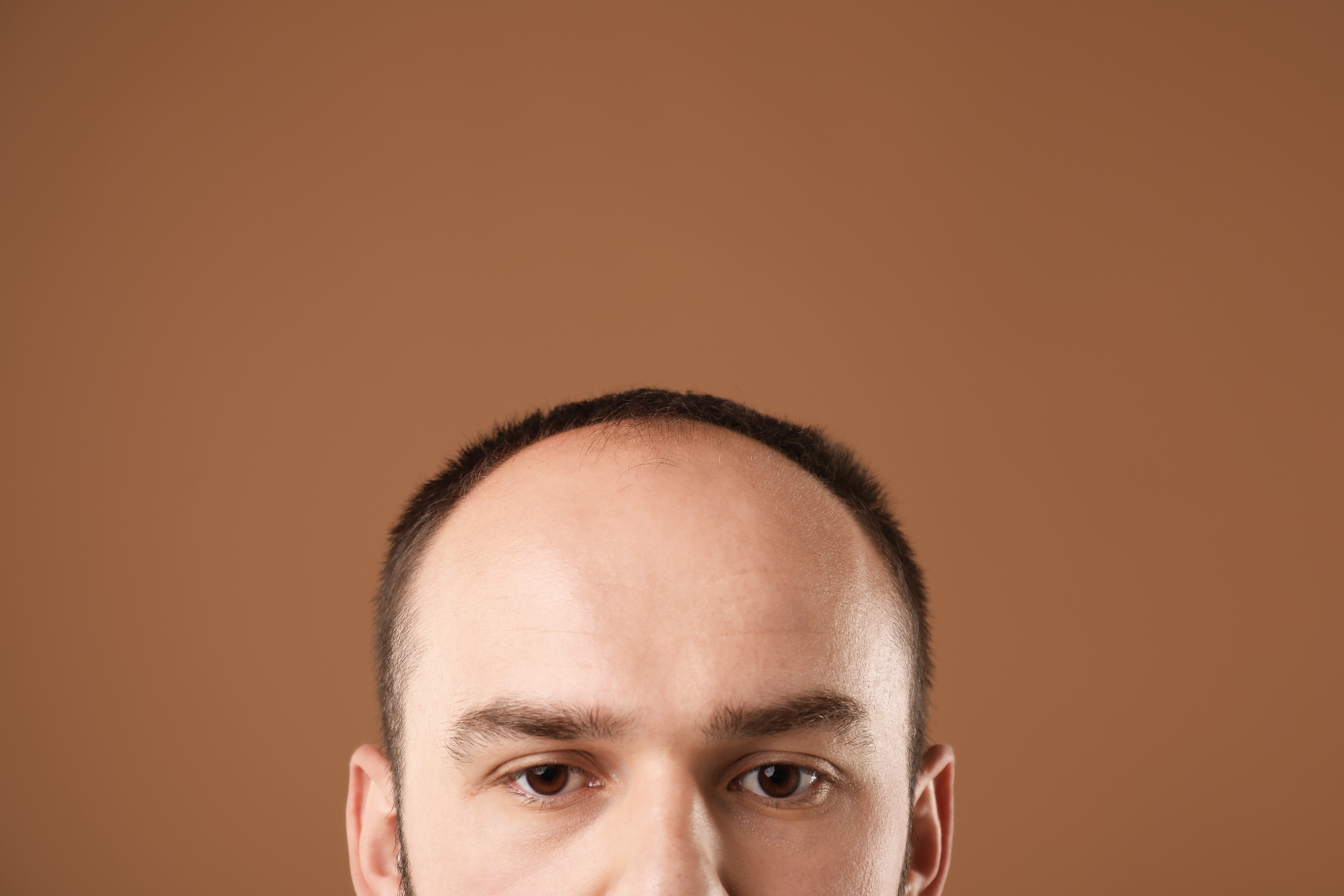 بالصور: أمراض فروة الرأس