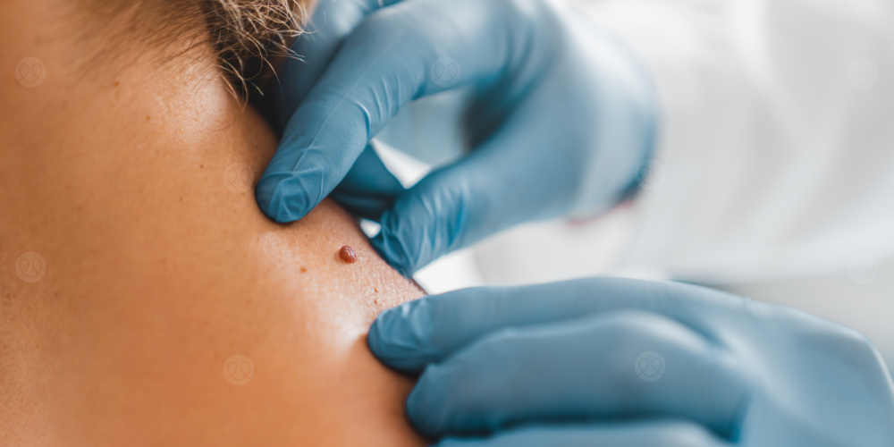 الزوائد الجلدية في الرقبة